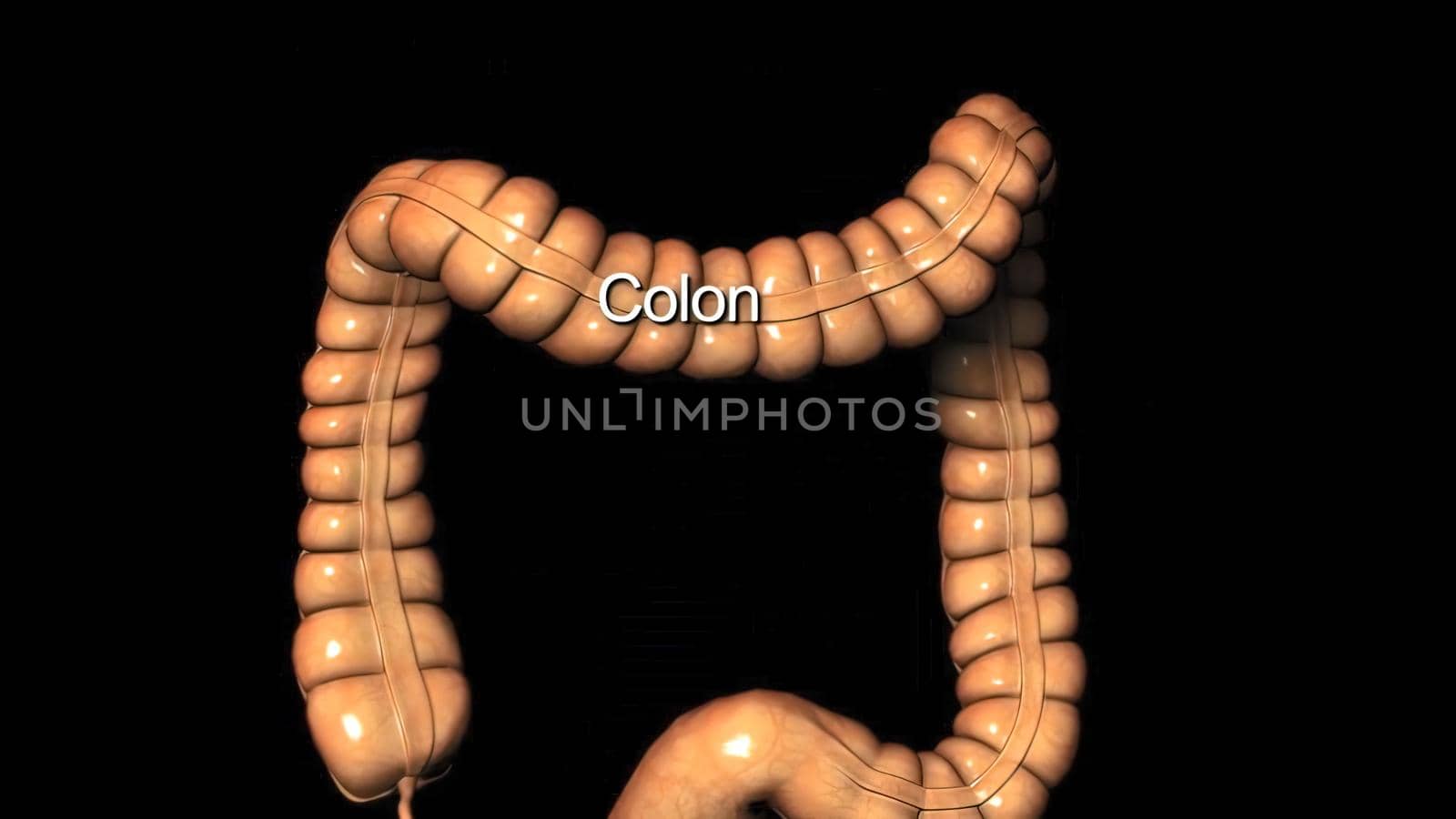 Colon during a enteroscopy with a intestinal or bowel cancer tumor visible. 3D illustration