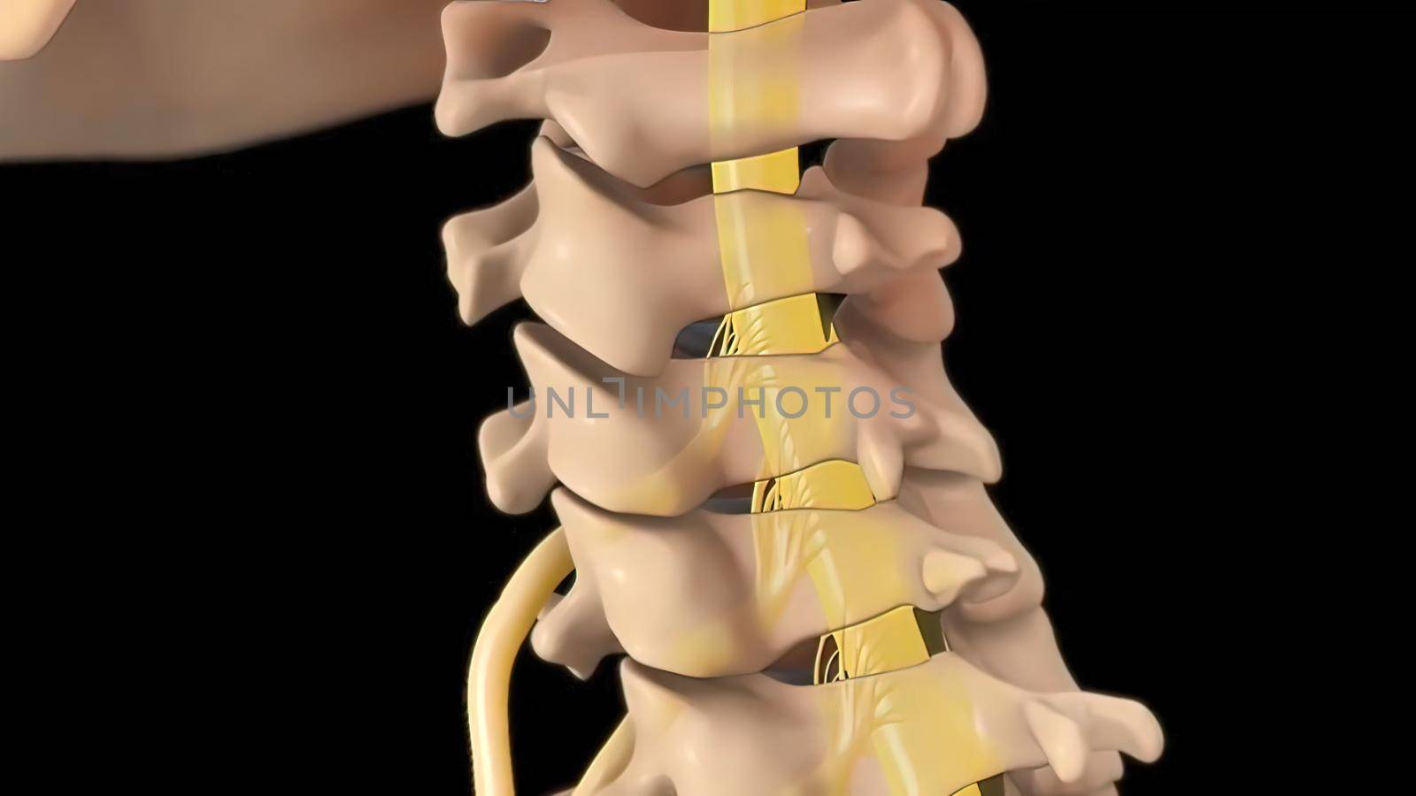 Anatomical view of the cervical spine with intervertebral disc-compressive nerve root prolapse. 3D illustration