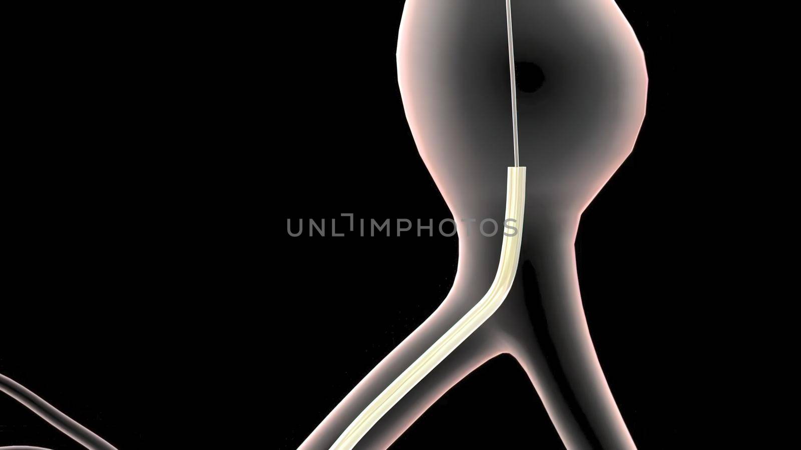 abdominal aortic aneurysm treatment by creativepic