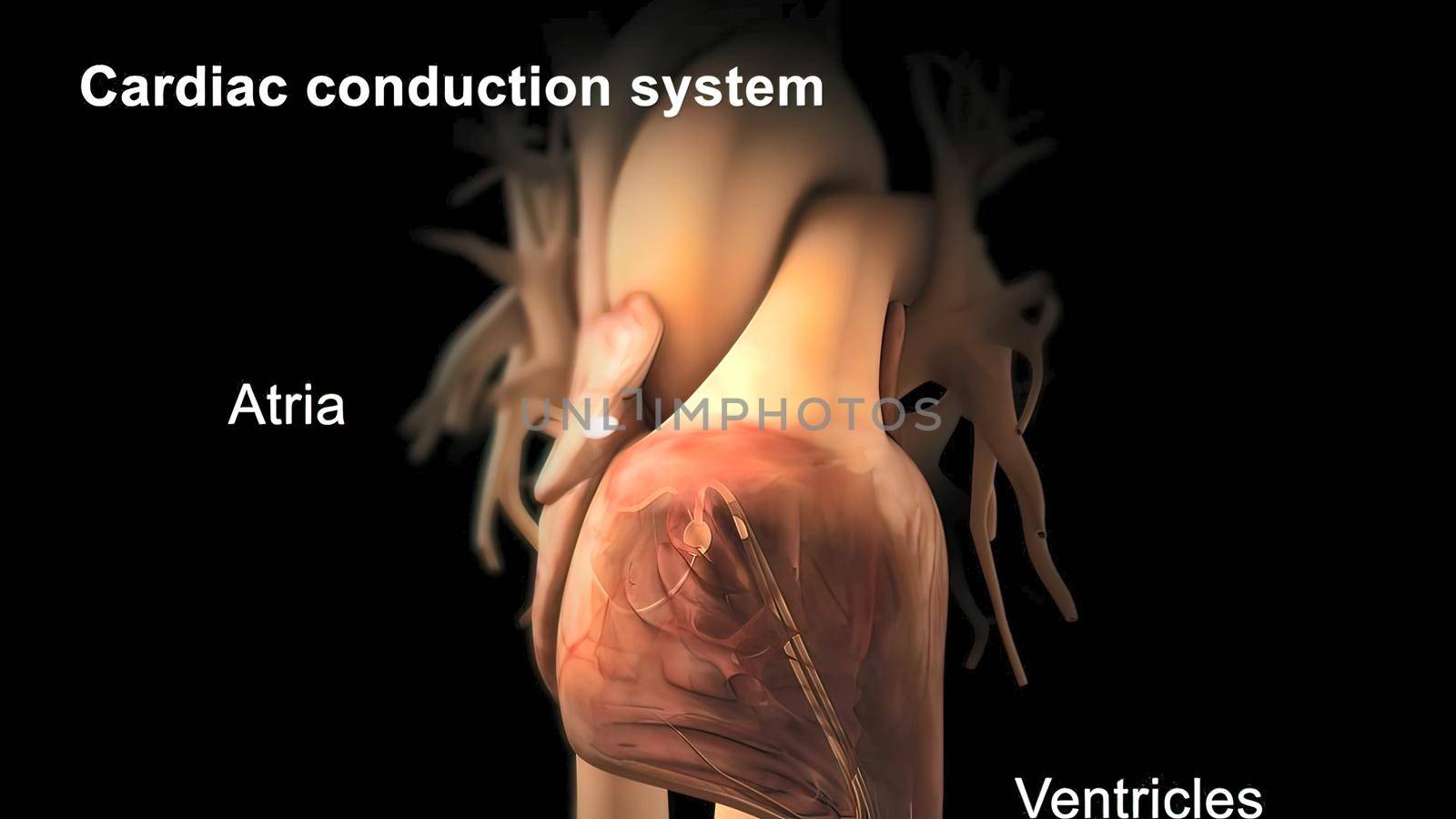 Catheter ablation is the treatment of arrhythmia with radio waves. 3D illustration