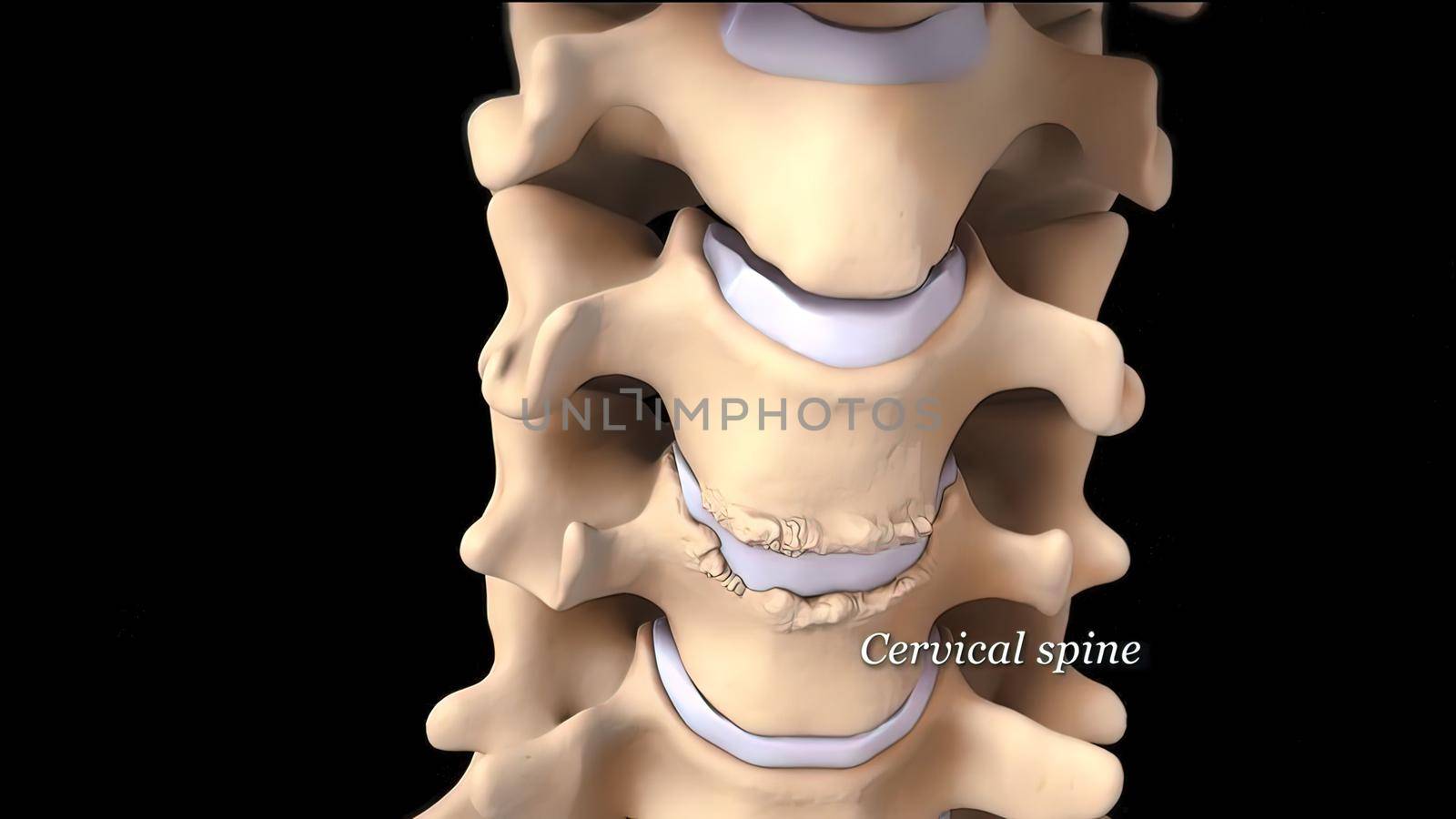 3D medical illustration of cervical spine on black background by creativepic