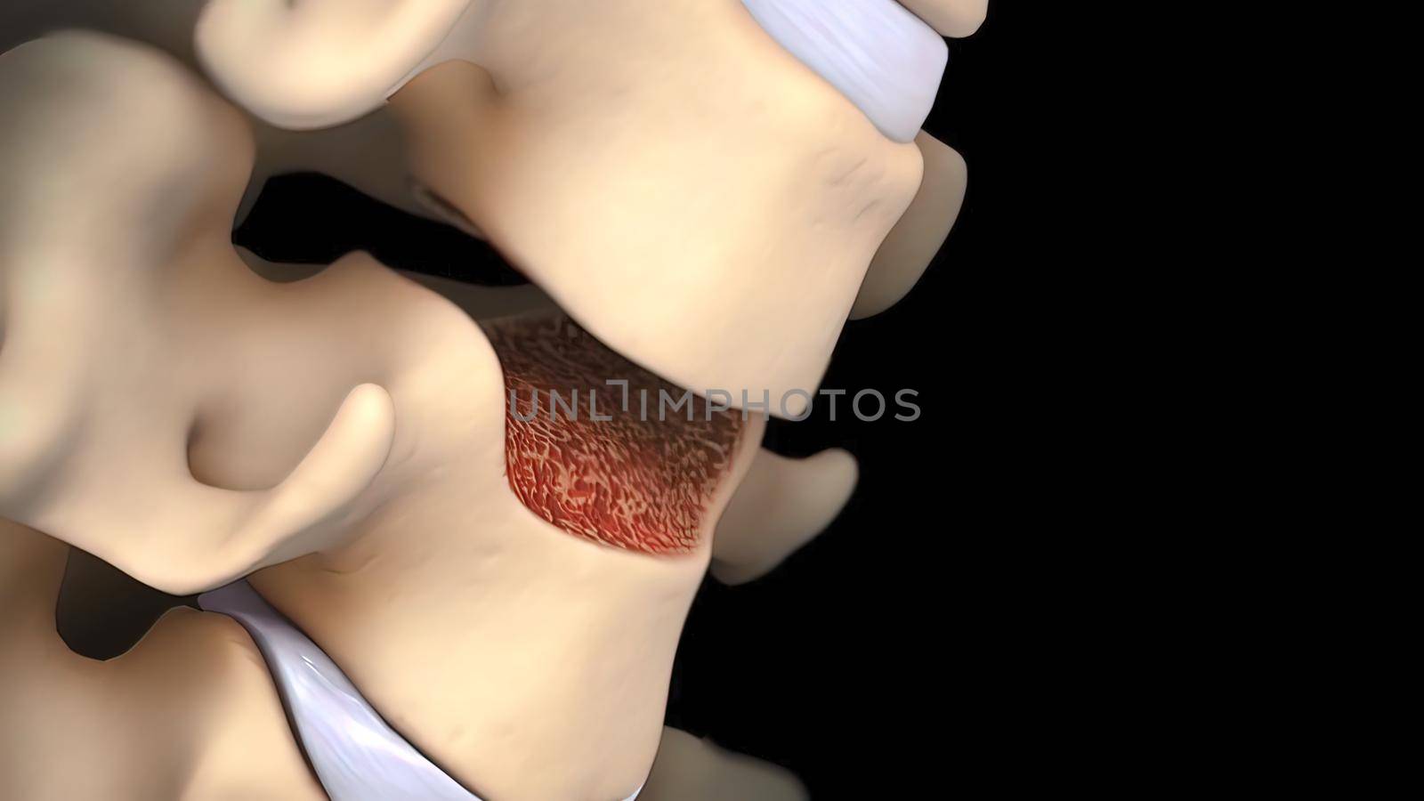 Spinal disc herniation is an injury to the cushioning and connective tissue between vertebrae, usually caused by excessive strain or trauma to the spine. 3D Render