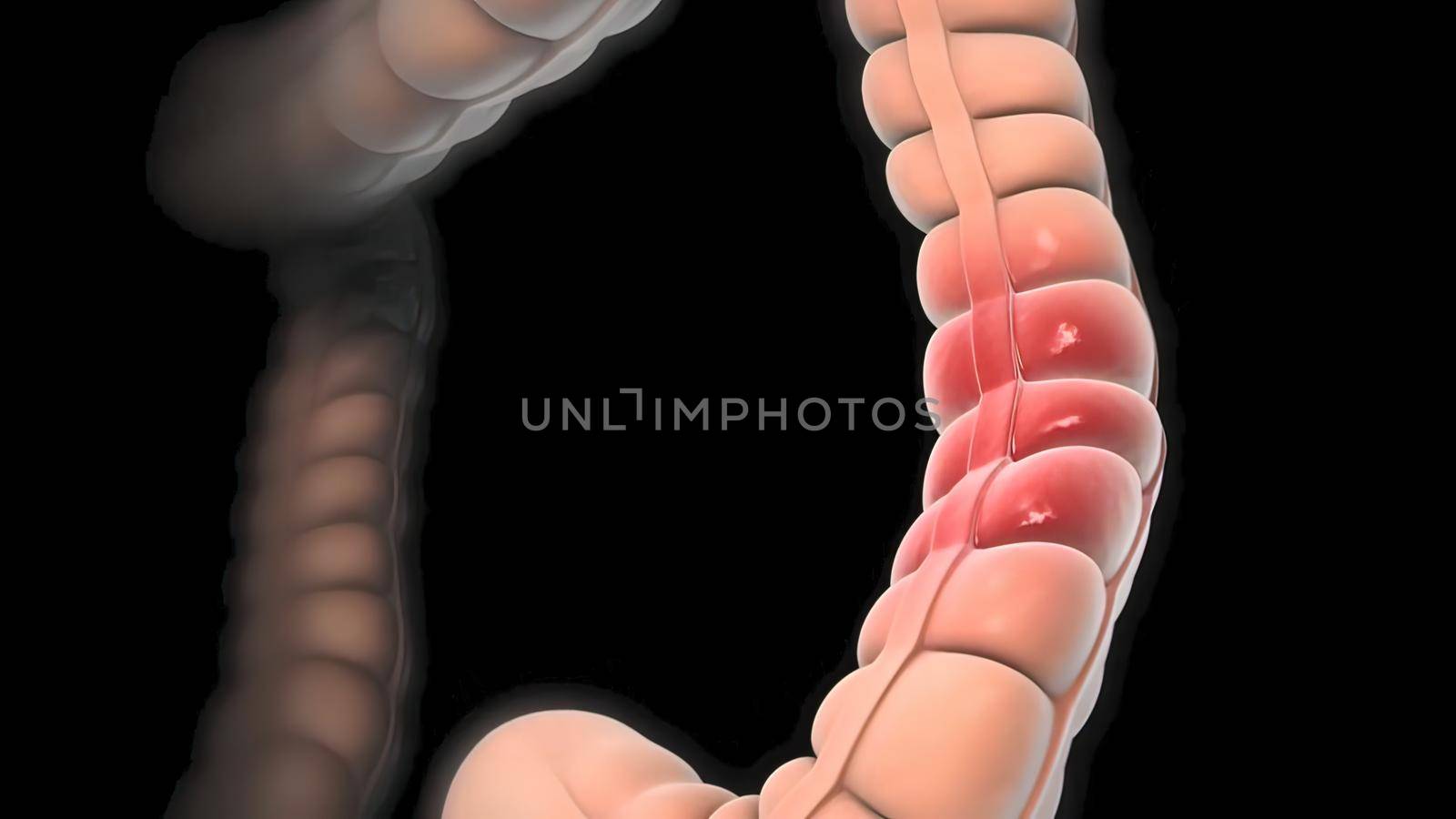 Magnifying glass of intestinal cancer. Tumor formation and growth 3D illustration