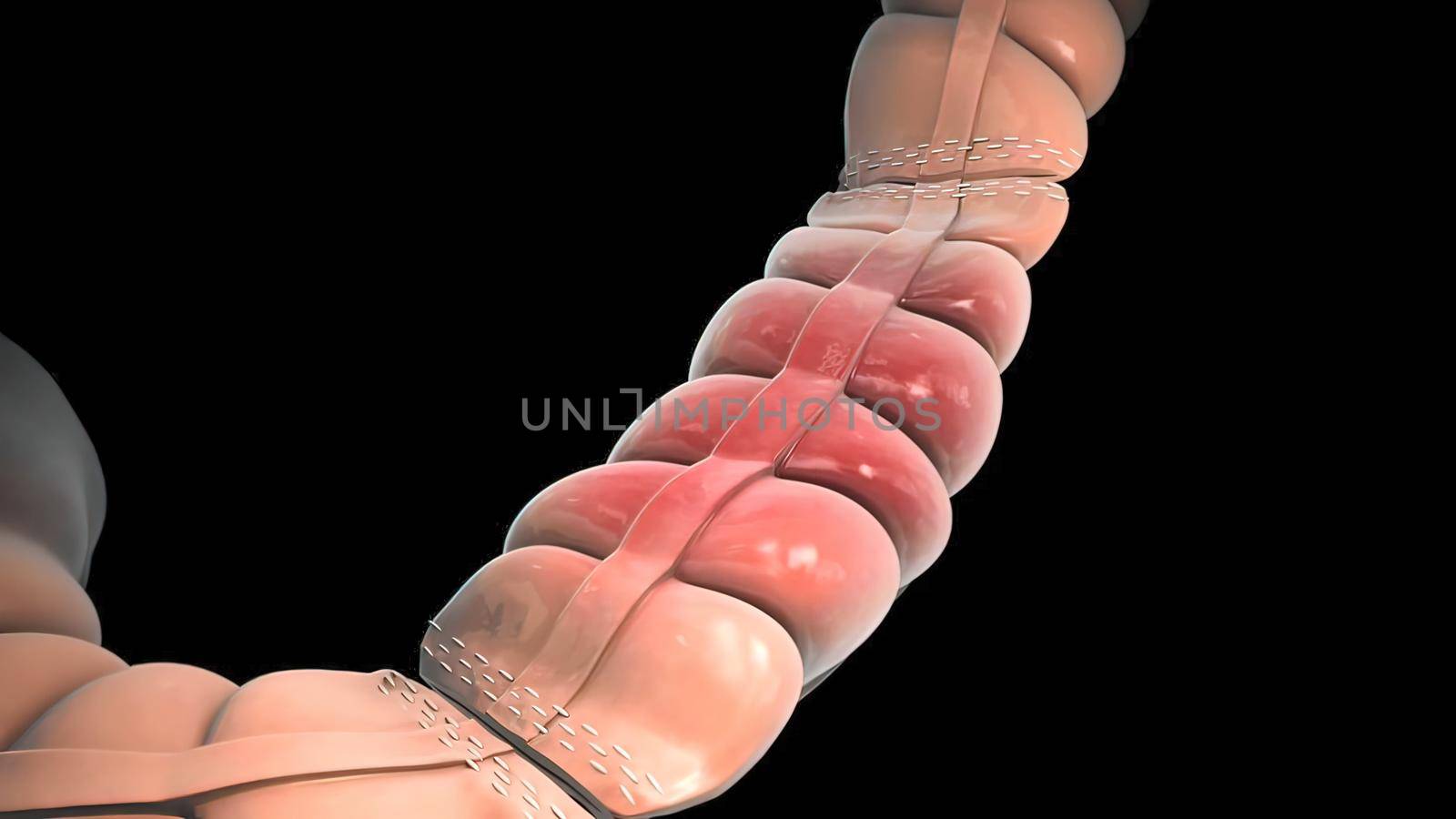 surgery to remove any part of the intestines, bowel resection by creativepic