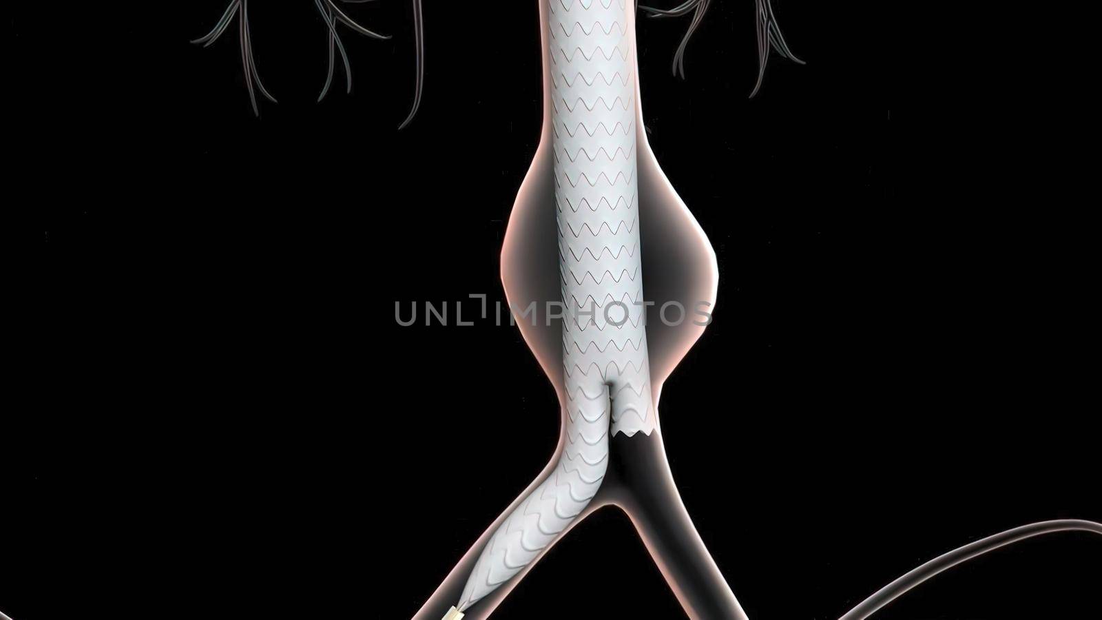 3D medical illustration of pulsatile Abdominal Aortic Aneurysm