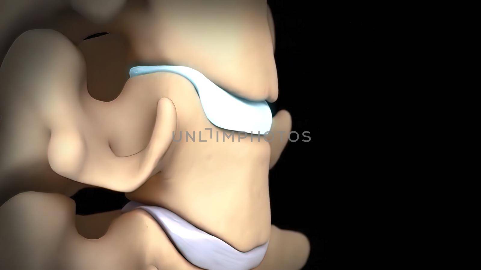 Pressure on nerves as a result of slipped disc 3D Render