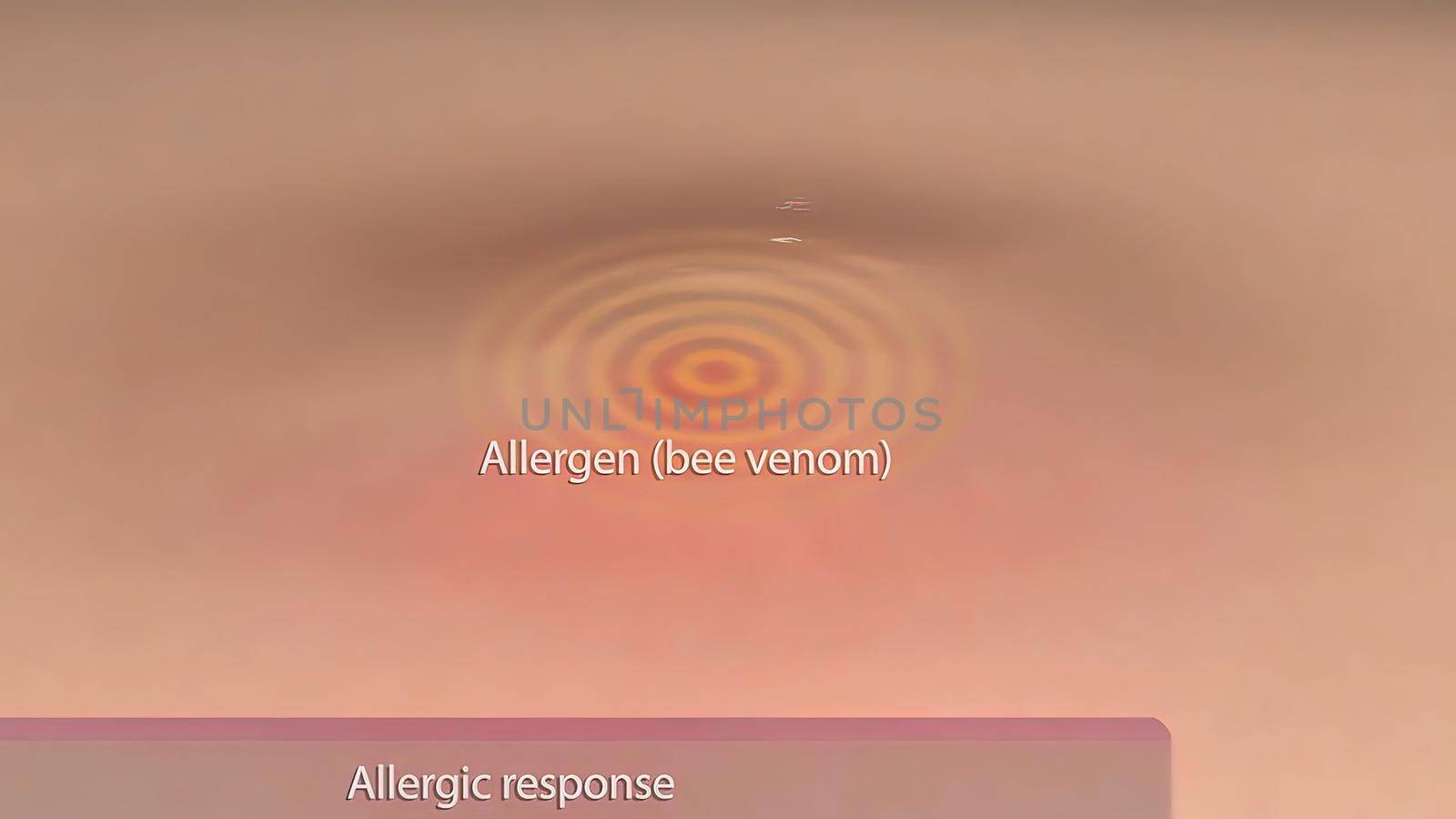 Allergic reaction on human skin .