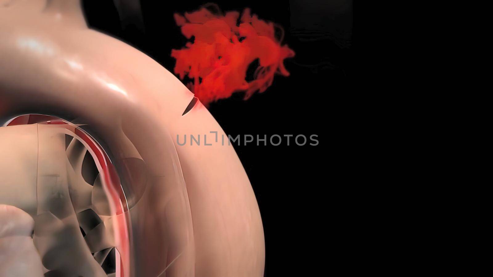 Aortic aneurysm and aortic dissection by creativepic