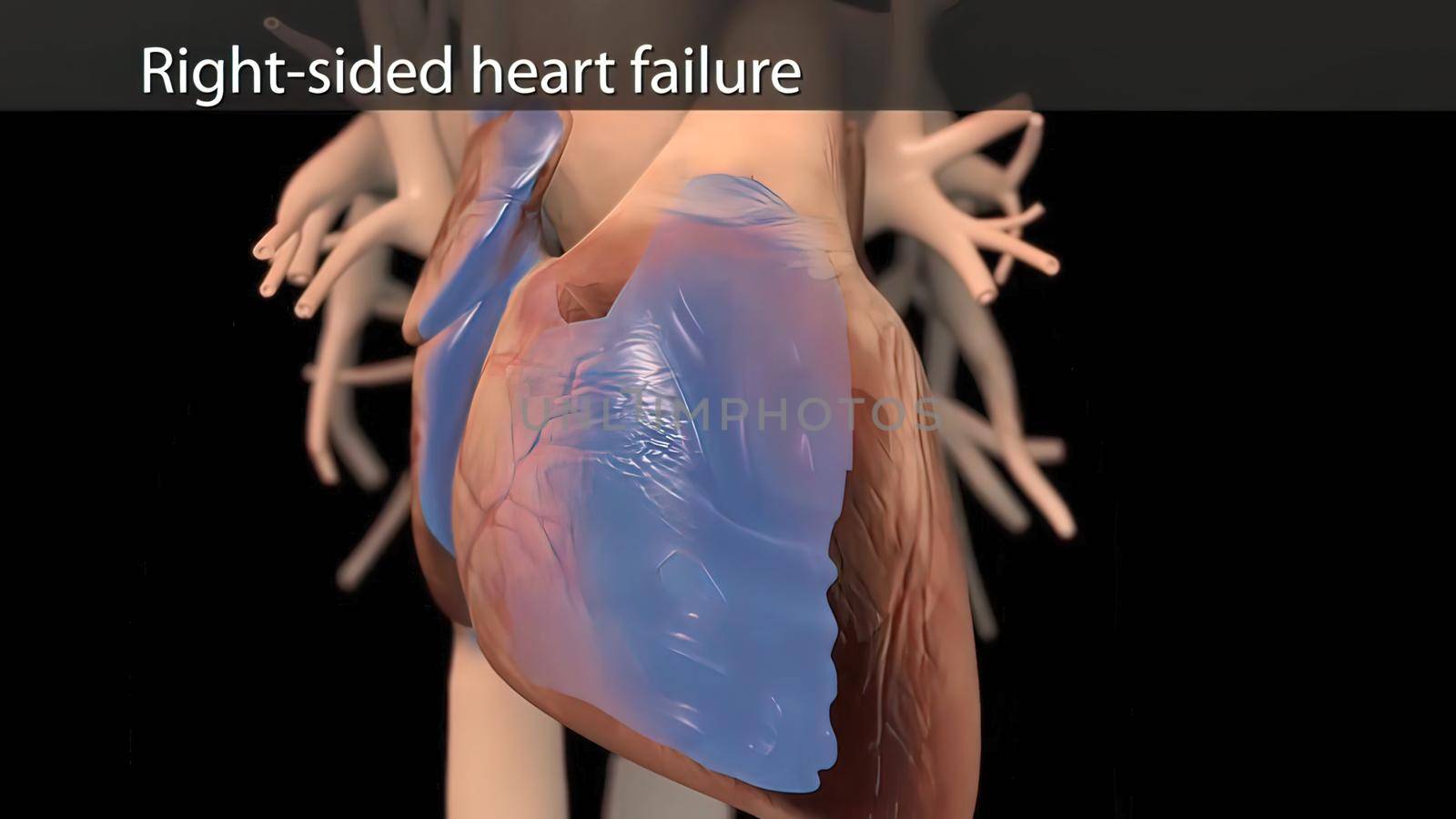 It means respiratory failure due to heart failure, edema, growth in the liver and obvious disease. 3D illustration