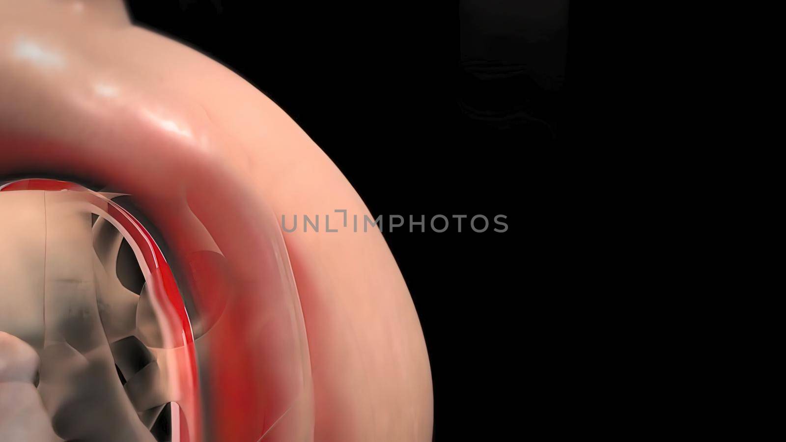 Aortic aneurysm and aortic dissection 3D Render