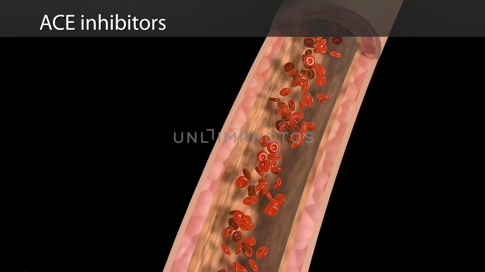 ACE inhibitors produce vasodilation by inhibiting the formation of angiotensin.