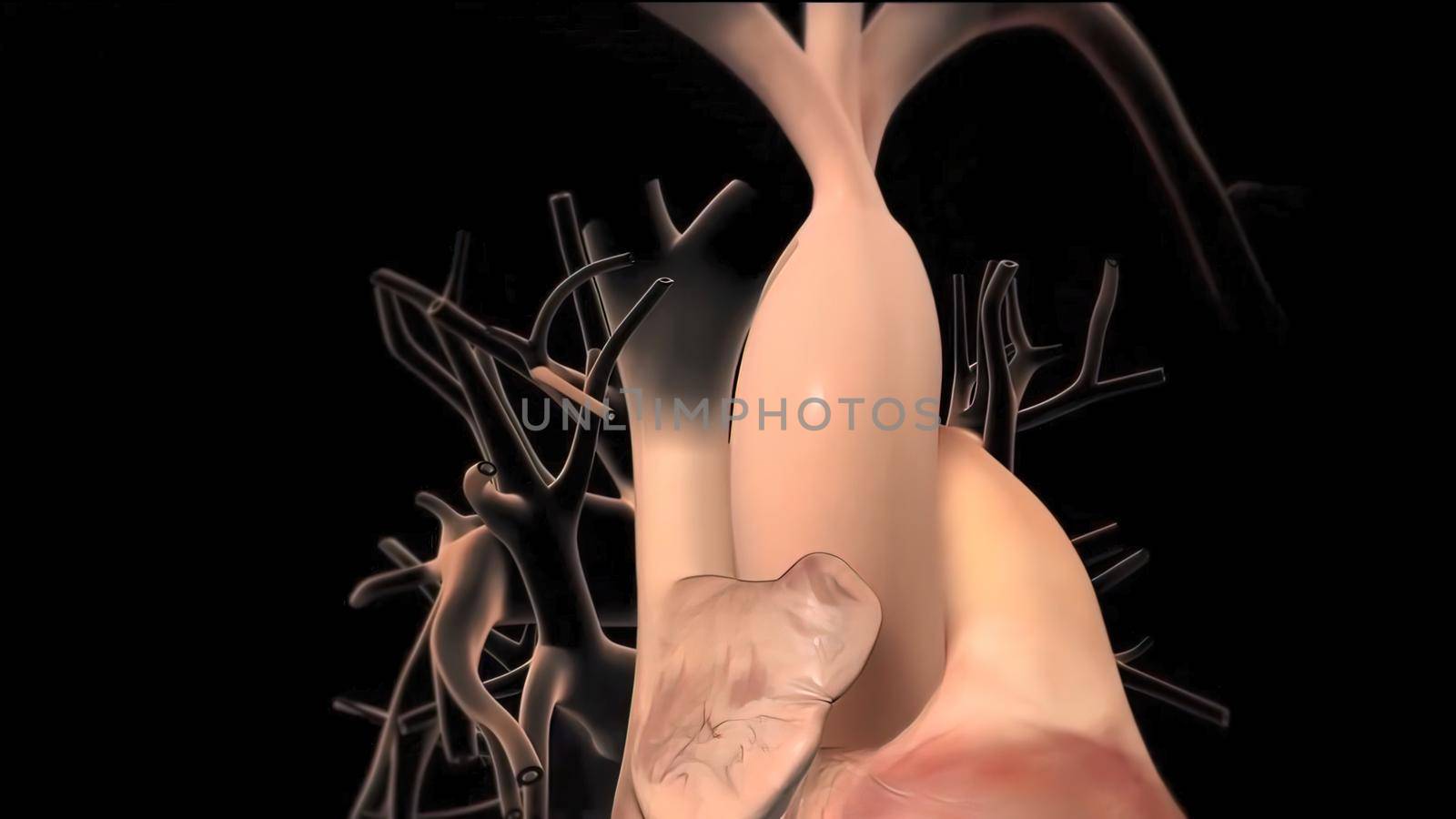 Hypoplastic left heart syndrome is a rare congenital heart defect in which the left side of the heart is severely underdeveloped.It may affect the left ventricle, aorta, aortic valve, or mitral valve. 3D Render