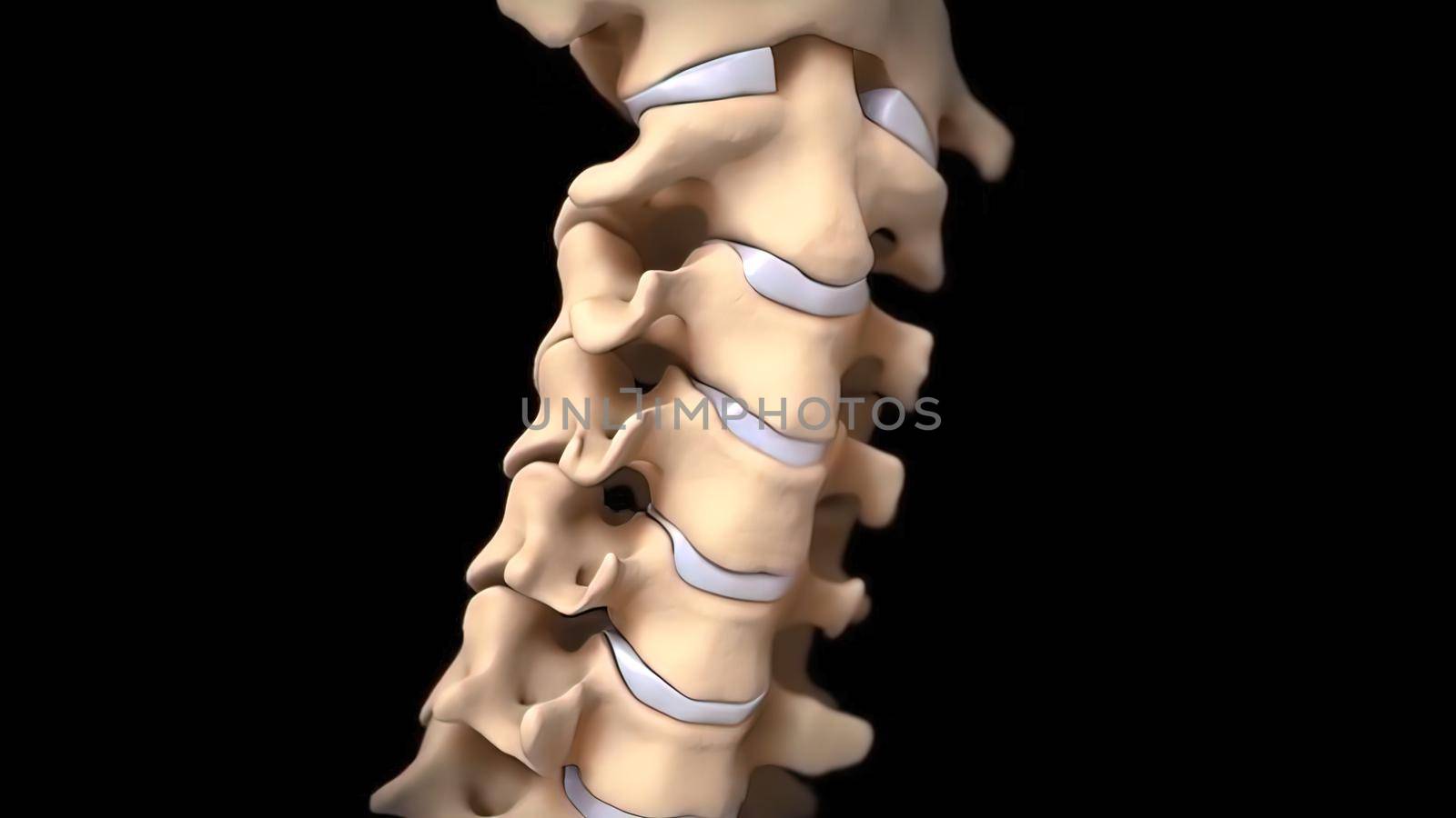 A spinal disc herniation is an injury to the cushioning and connective tissue between the vertebrae. by creativepic