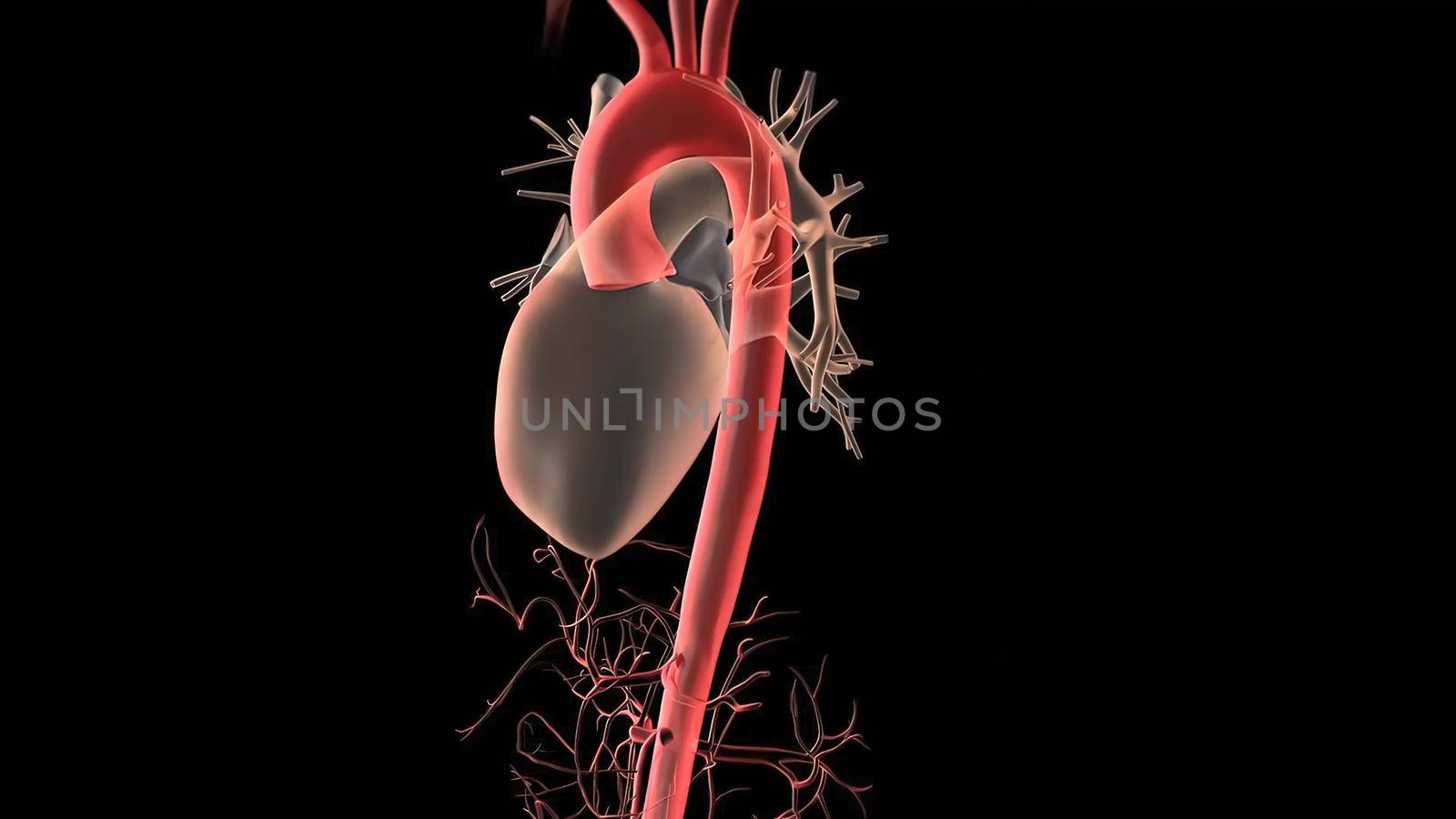 Aortic aneurysm and aortic dissection 3D Render