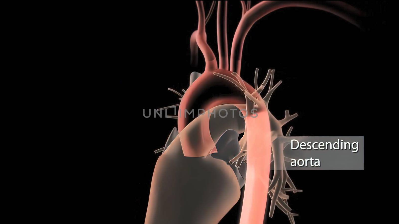 Hypoplastic left heart syndrome is a rare congenital heart defect in which the left side of the heart is severely underdeveloped.It may affect the left ventricle, aorta, aortic valve, or mitral valve. 3D Render