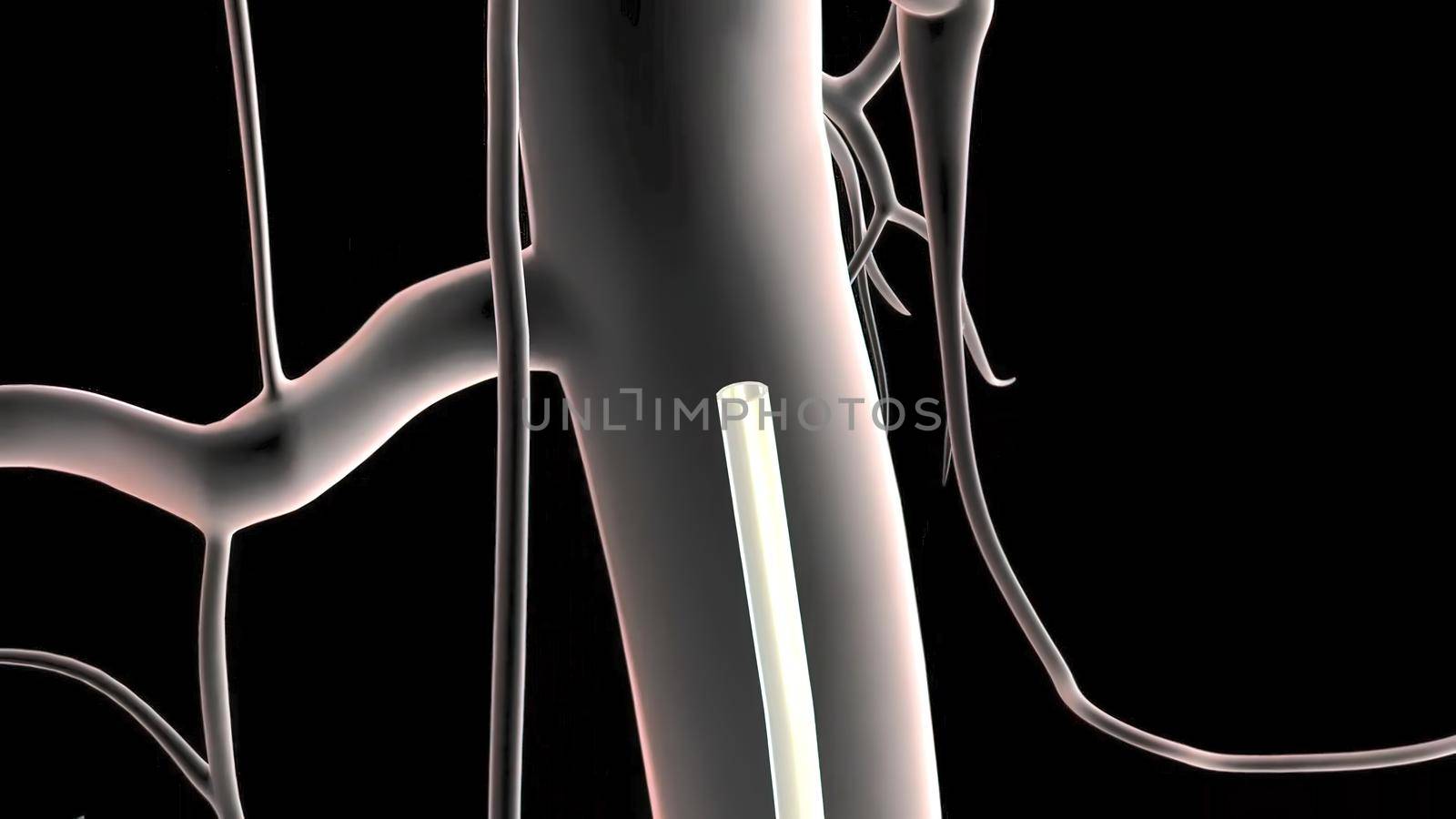 An abdominal aortic aneurysm occurs when a lower portion of the body's main artery (aorta) becomes weakened and bulges