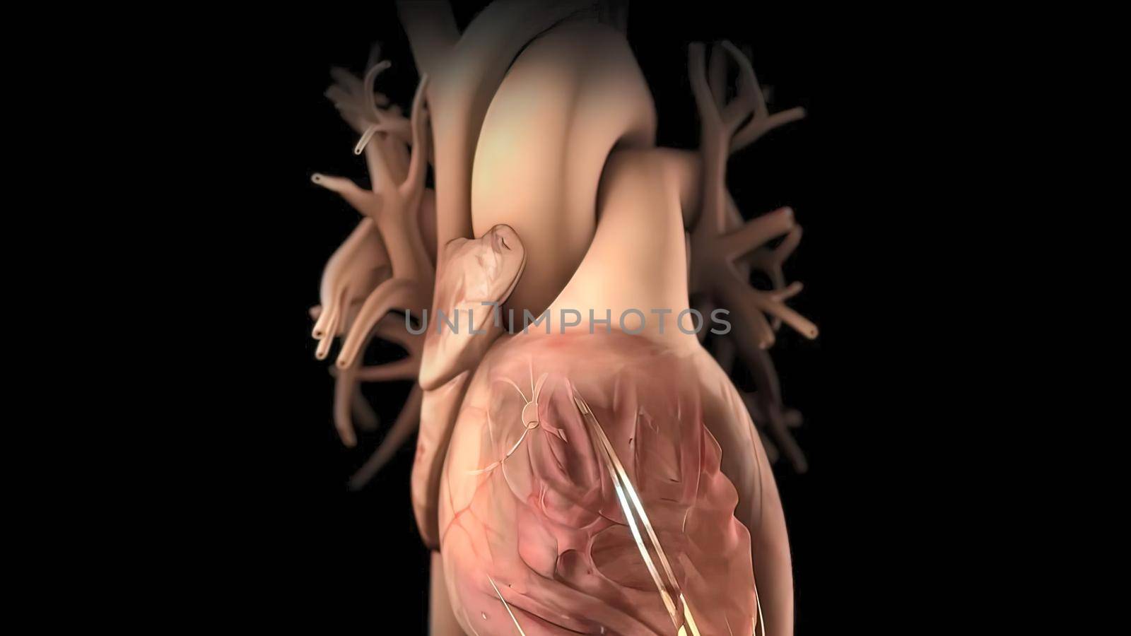 Arrhythmia The normal electrical activity of the heart is the result of the electrical activity of the area called the sinus node 3D Medical illustration