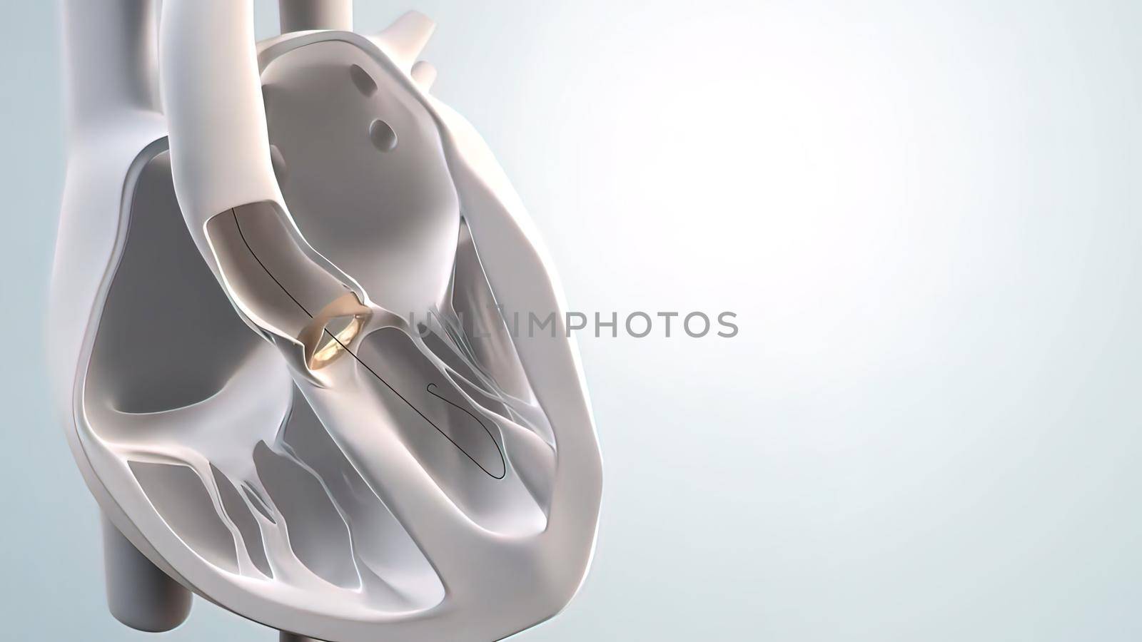 Expansion of transcatheter aortic valve implantation.3D Medical 3D Render .