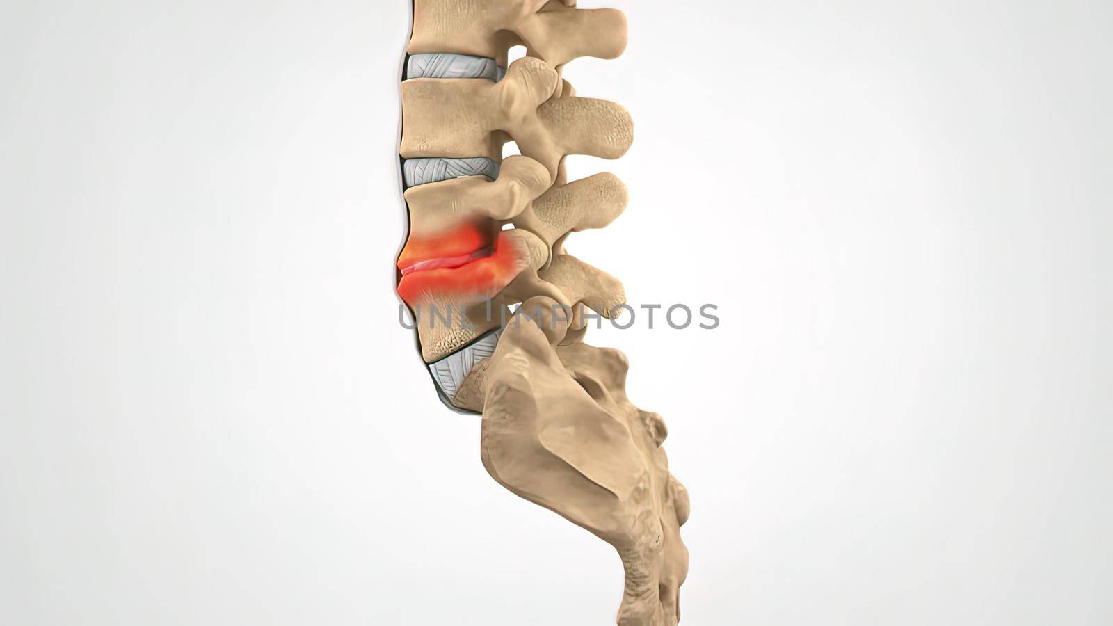 Backbone Laminectomy Degenerative Dics Disease 3D illustration