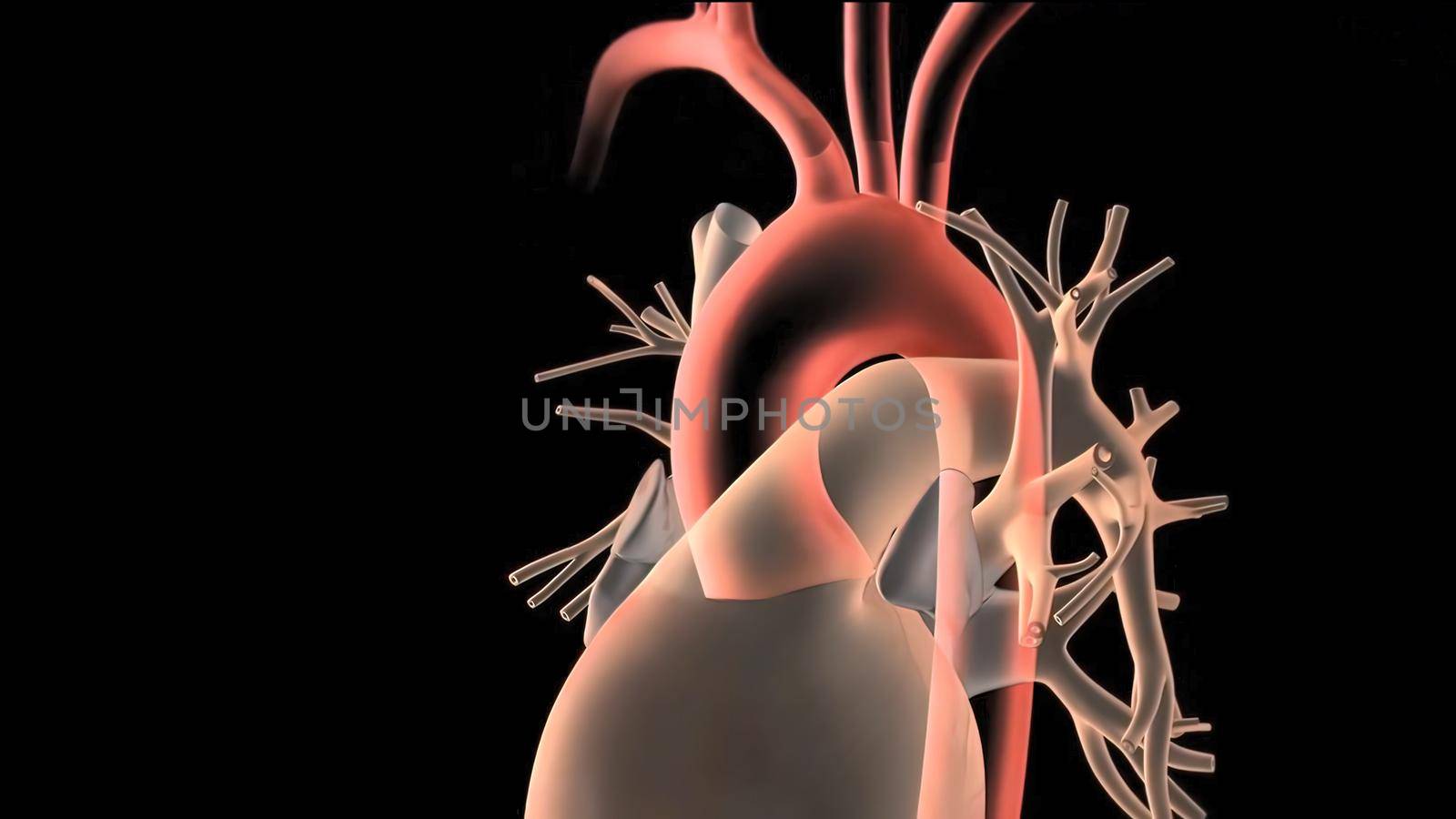 Hypoplastic left heart syndrome is a rare congenital heart defect in which the left side of the heart is severely underdeveloped.It may affect the left ventricle, aorta, aortic valve, or mitral valve. 3D Render