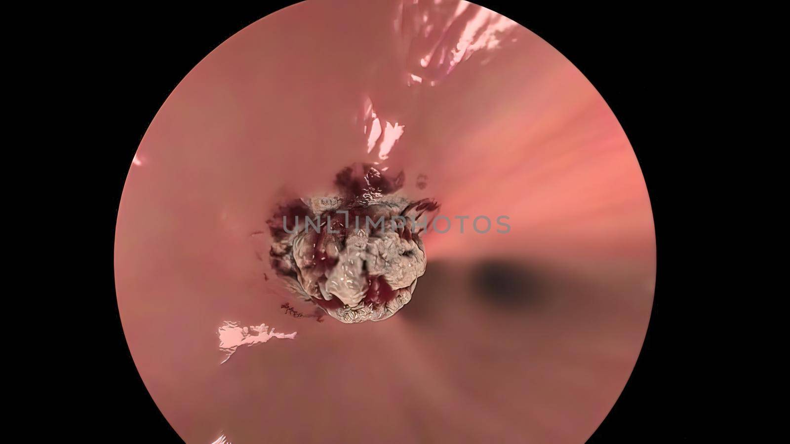 Removal of the tumor by confirming the condition of the lungs using a bronchoscope and fluorescent imaging 3D illustration