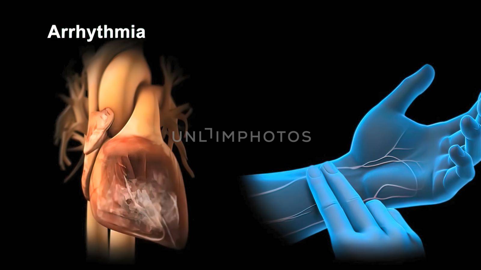 The abnormal fast human heart increased heart rhythm rate at which it was in cardiac arrest, anxiety, or panic attacks, 3D Render