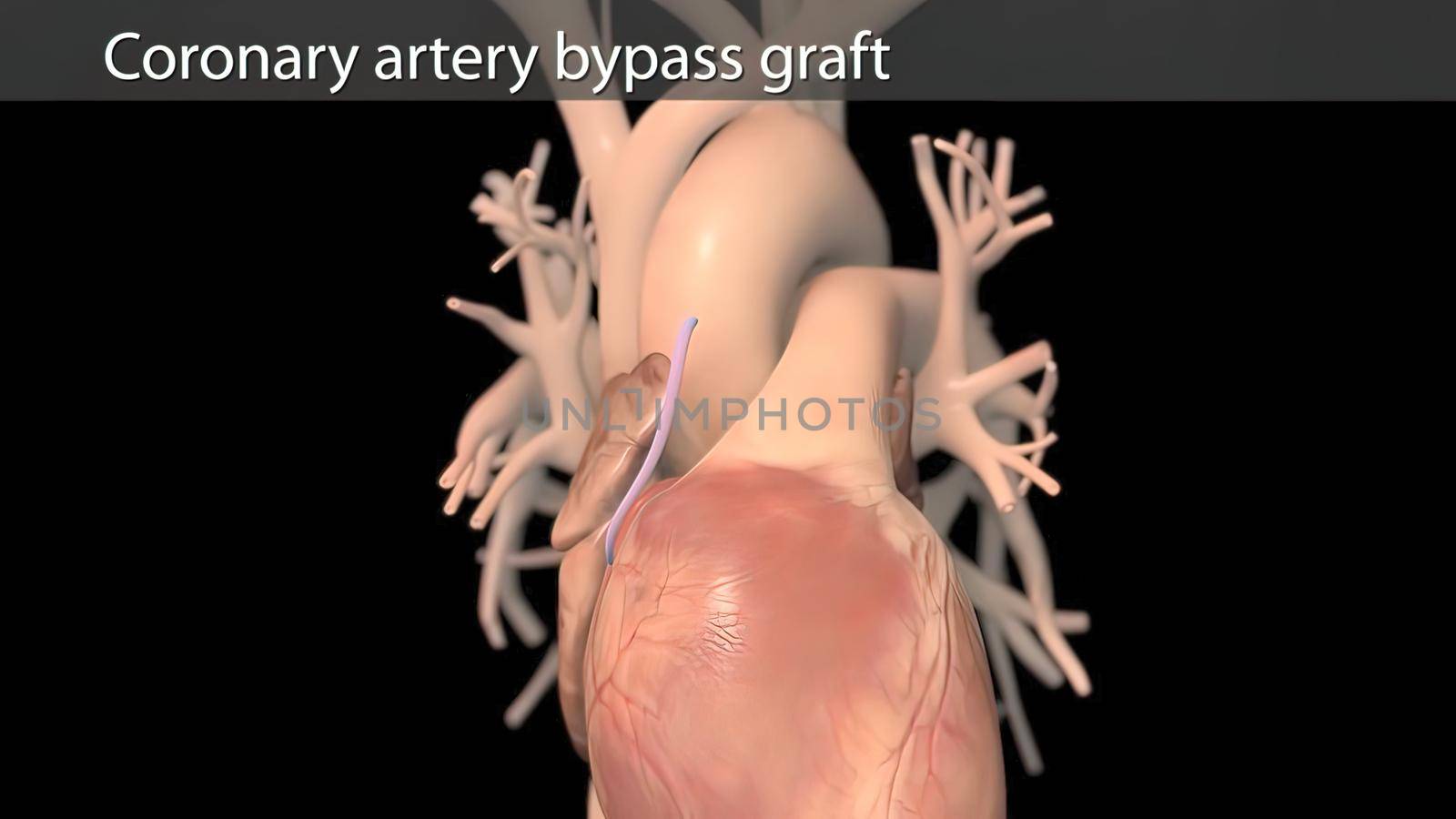 Coronary artery bypass surgery is done using a healthy blood vessel called a graft. 3D illustration