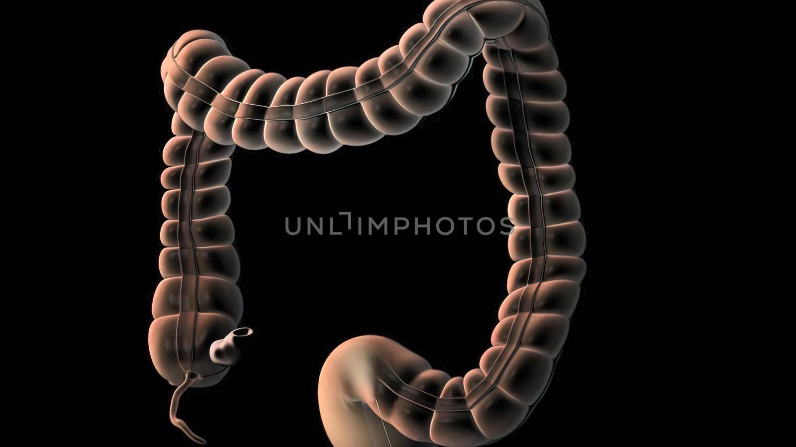 During a colonoscopy, a long, fleible tube (colonoscope) is inserted into the rectum. 3D illustration