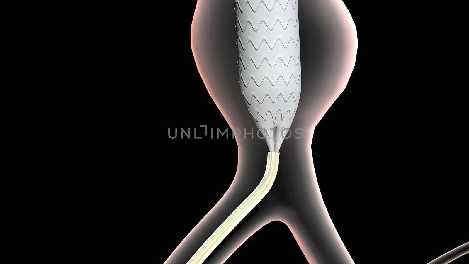 abdominal aortic aneurysm treatment by creativepic