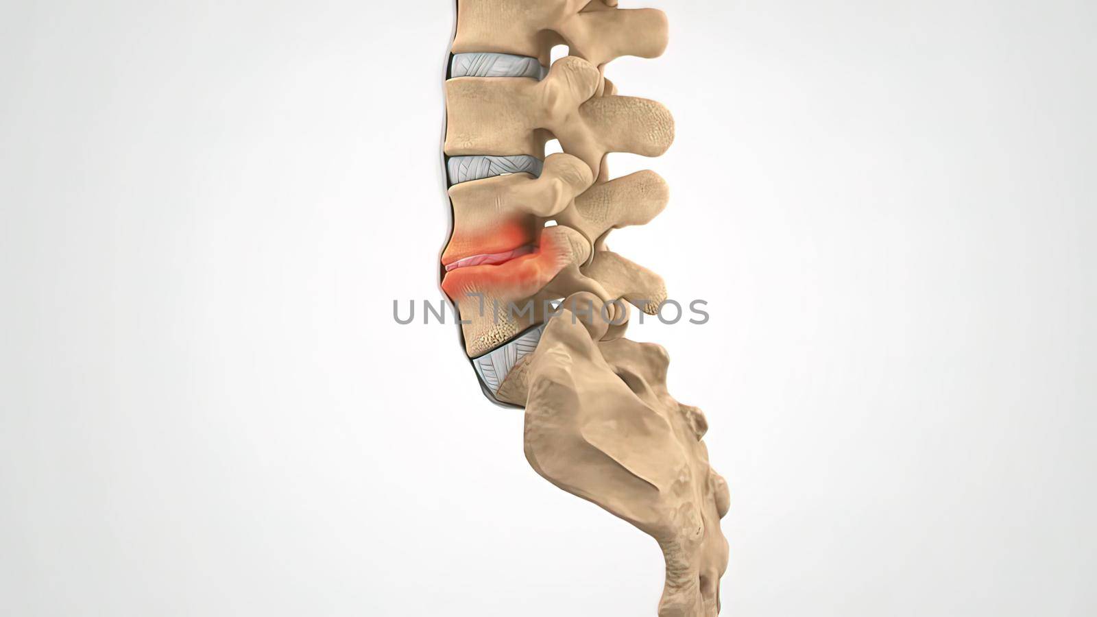 Backbone Laminectomy Degenerative Dics Disease 3D illustration