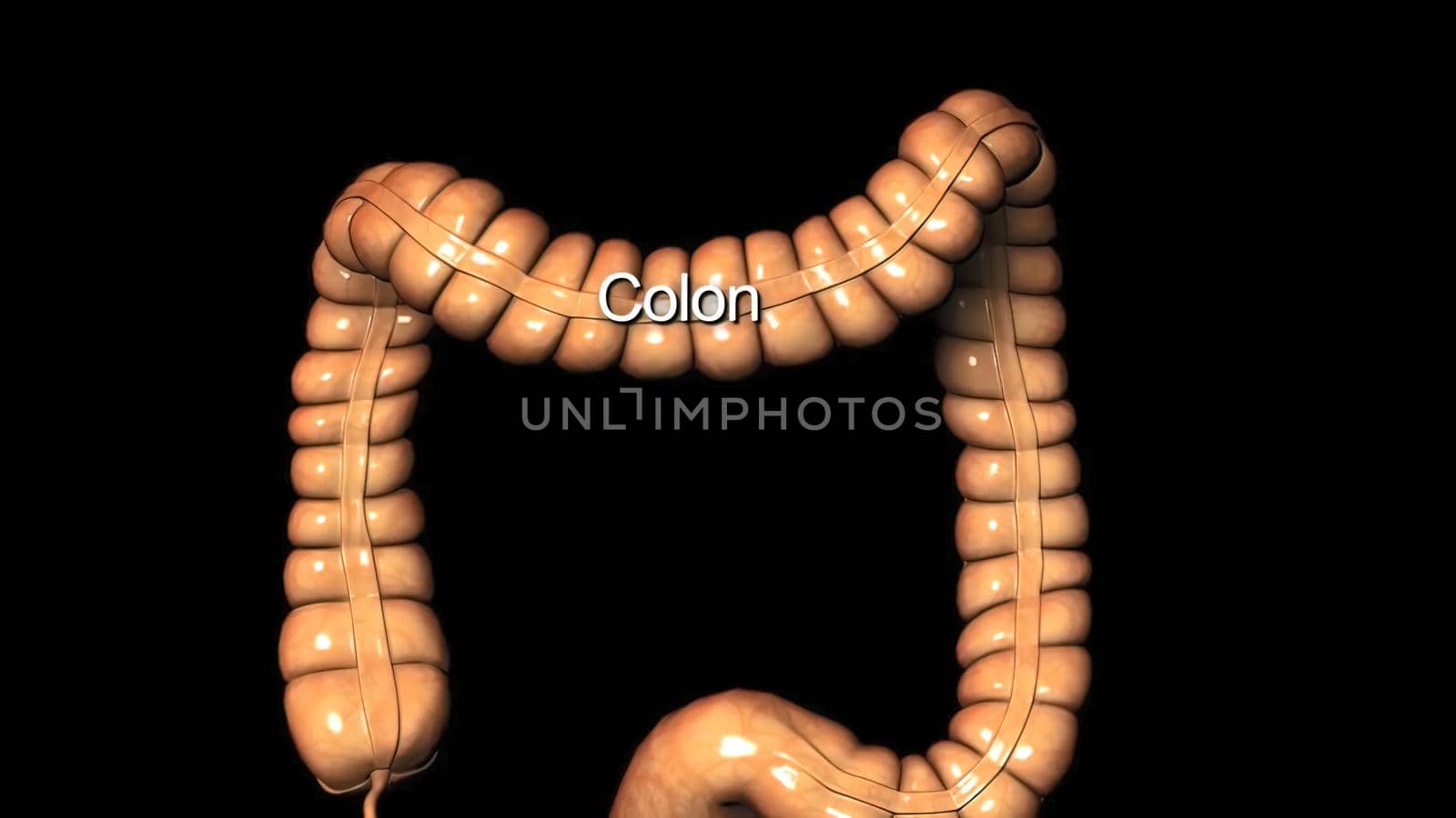 Colon during a enteroscopy with a intestinal or bowel cancer tumor visible. by creativepic