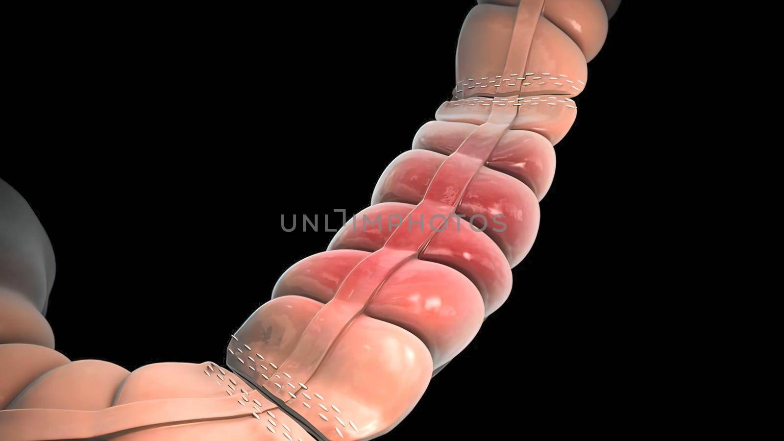 Magnifying glass of intestinal cancer. Tumor formation and growth 3D illustration