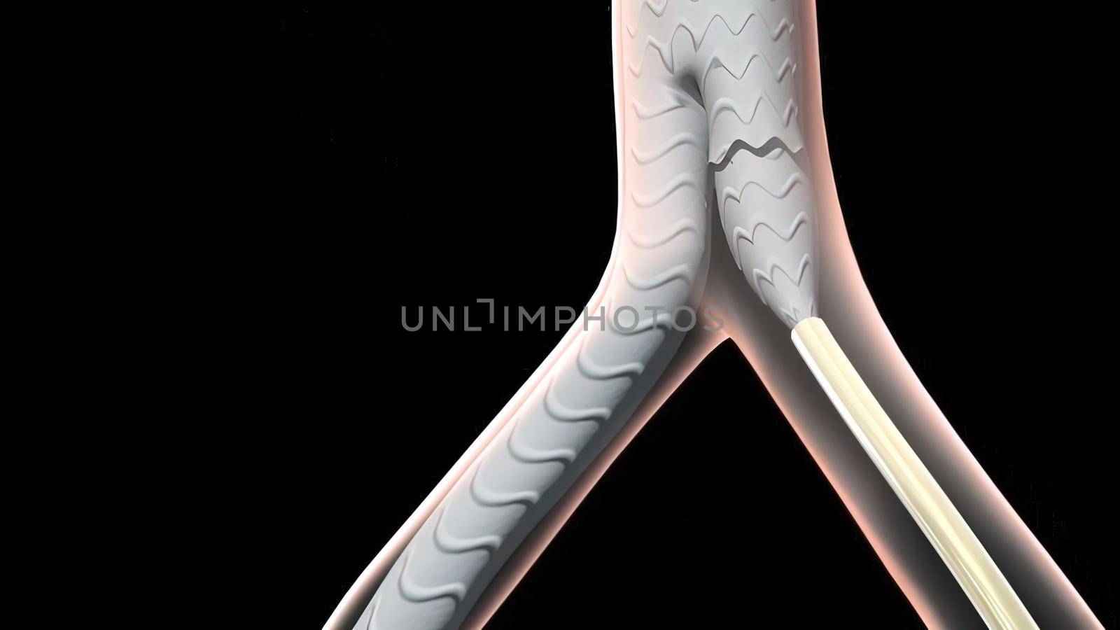 3D medical illustration of pulsatile Abdominal Aortic Aneurysm by creativepic