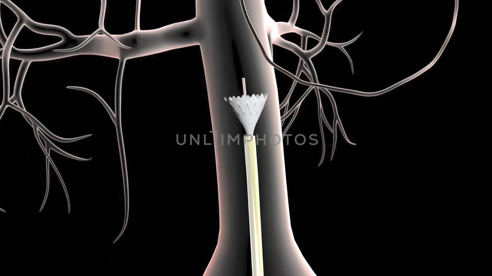 abdominal aortic aneurysm treatment by creativepic