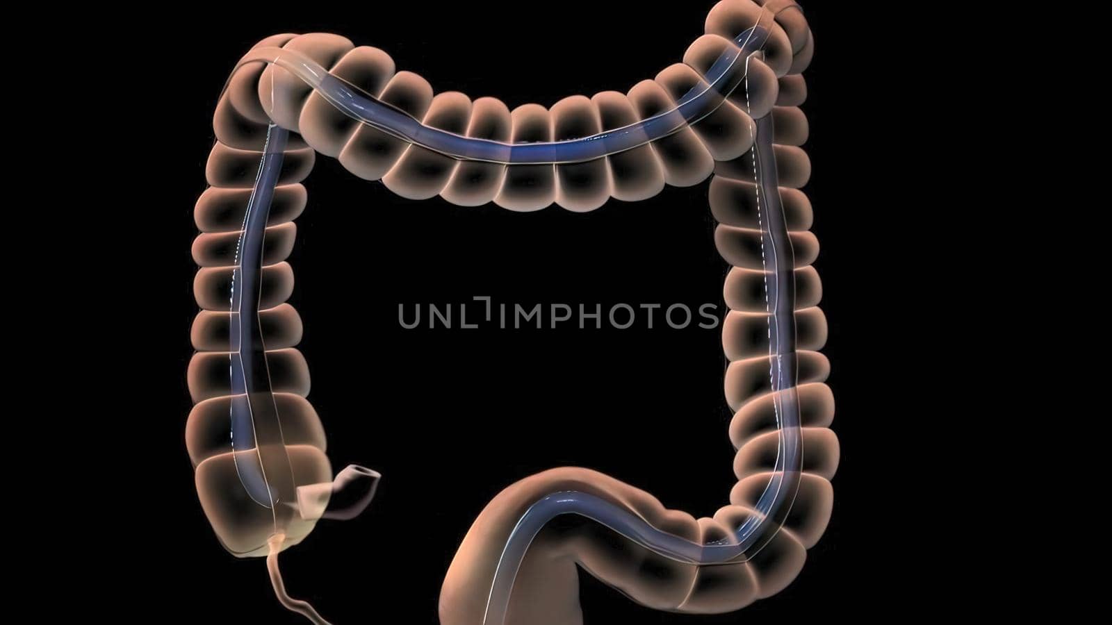 Colonoscopy Biopsy Of The Gastrointestinal Tract In Patients 3D illustration