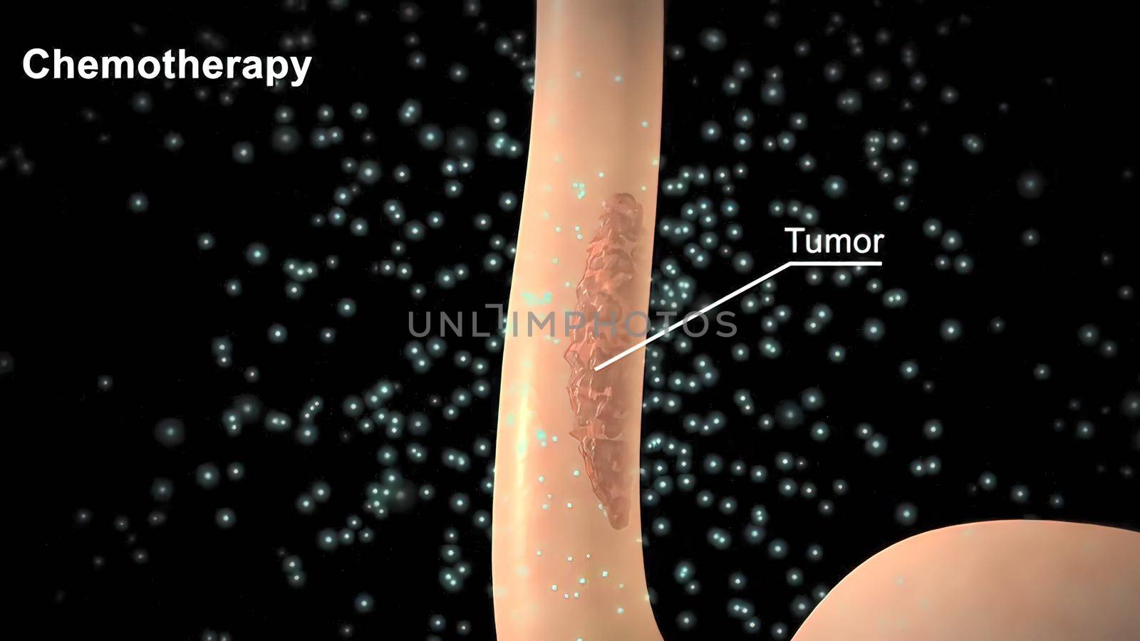 Cancer cell death, tumor death, destruction of normal cells and tissue. It also covers the side effects associated with chemotherapy treatments. 3D illustration