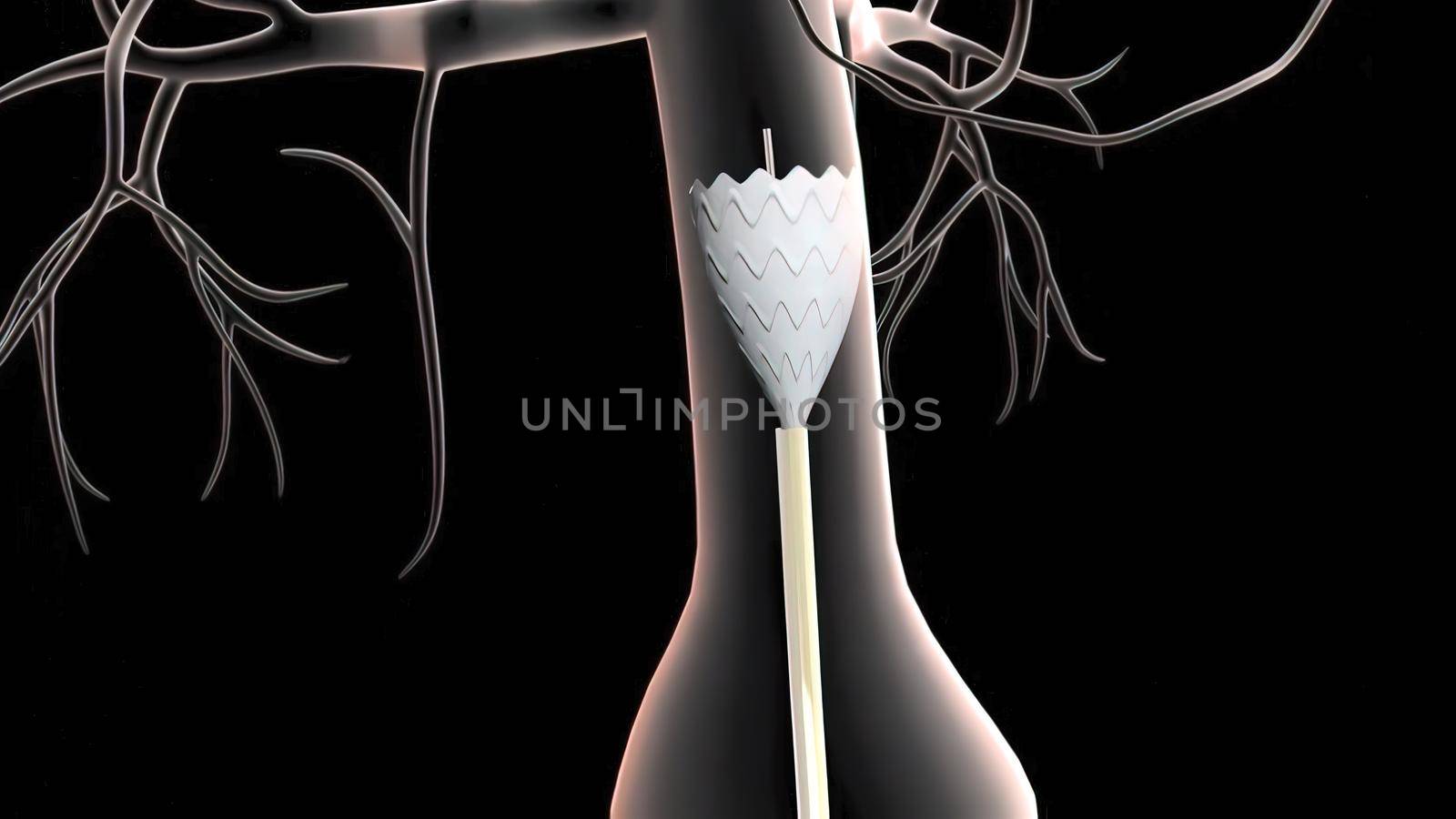3D medical illustration of pulsatile Abdominal Aortic Aneurysm by creativepic