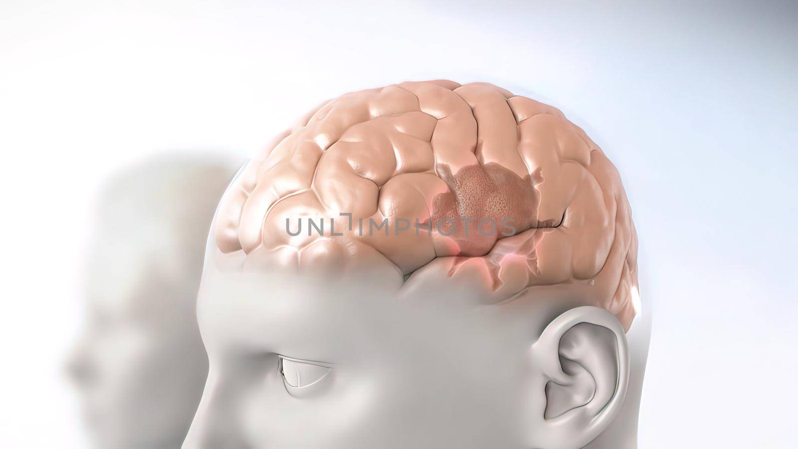 A brain tumor occurs when abnormal cells form within the brain. There are two main types of tumors. Cancerous tumors and benign tumors. 3d illustration