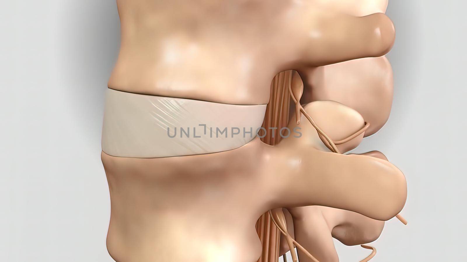 Pressure applied to the nerve as a result of the fracture of the spinal disc 3D illustration