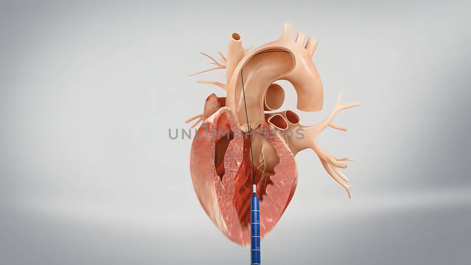 Coronary reimplantation in ascending aortic aneurysm 3D Render