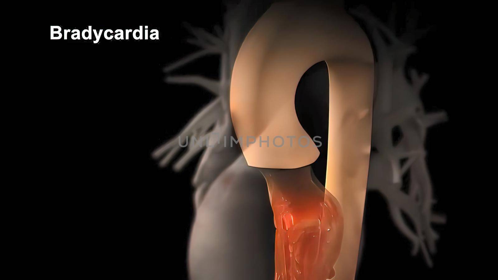 The bradycardia abnormally slow heart action 3D illustration