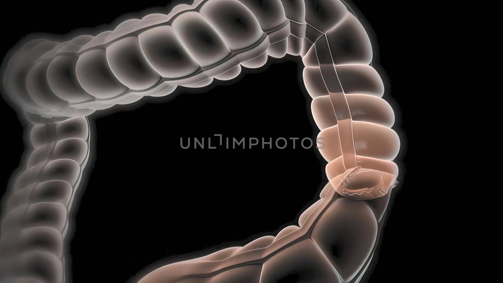 surgery to remove any part of the intestines, bowel resection by creativepic