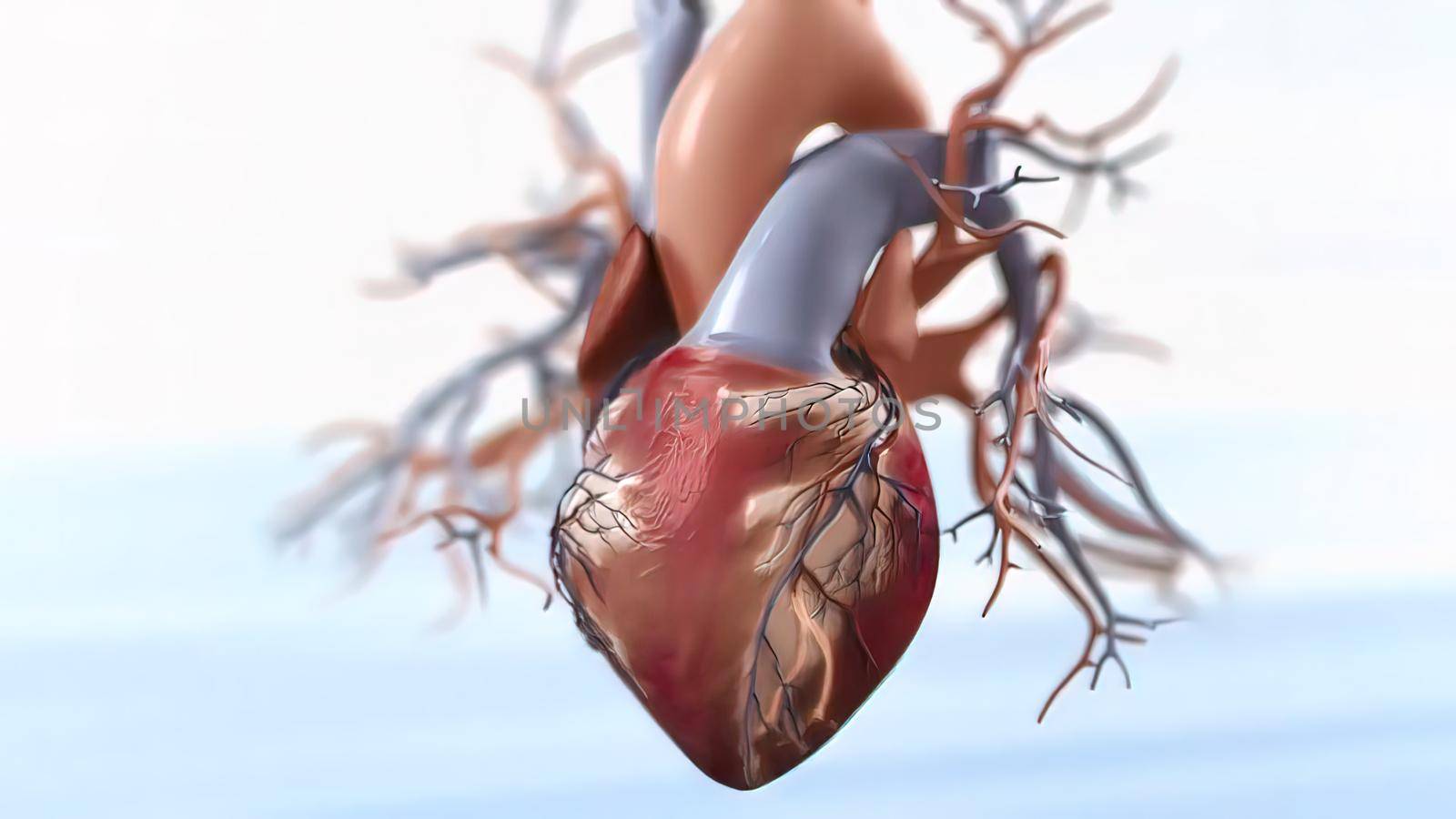 Acute Coronary Syndrome 3d medical by creativepic