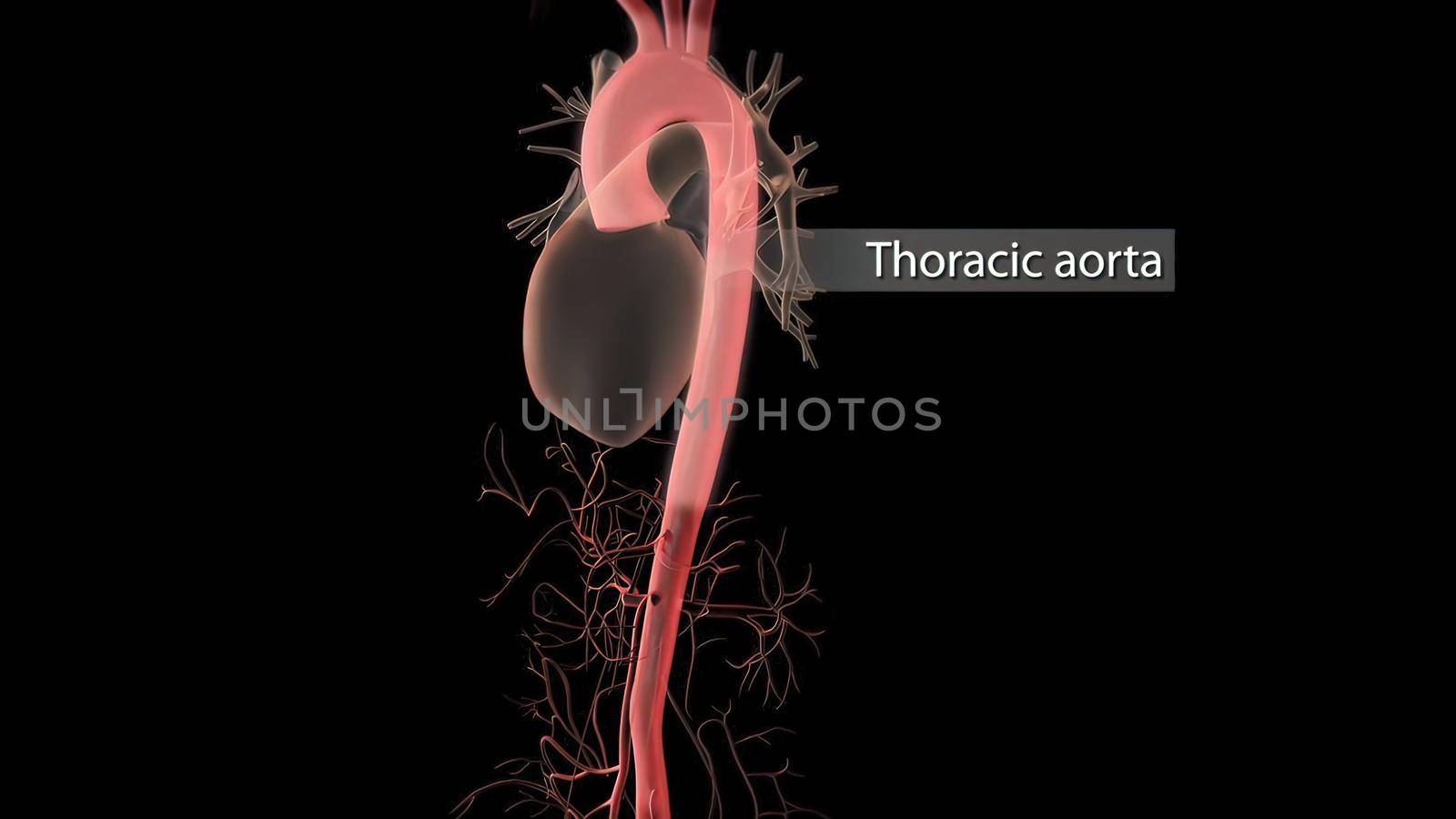 Aortic aneurysm and aortic dissection by creativepic