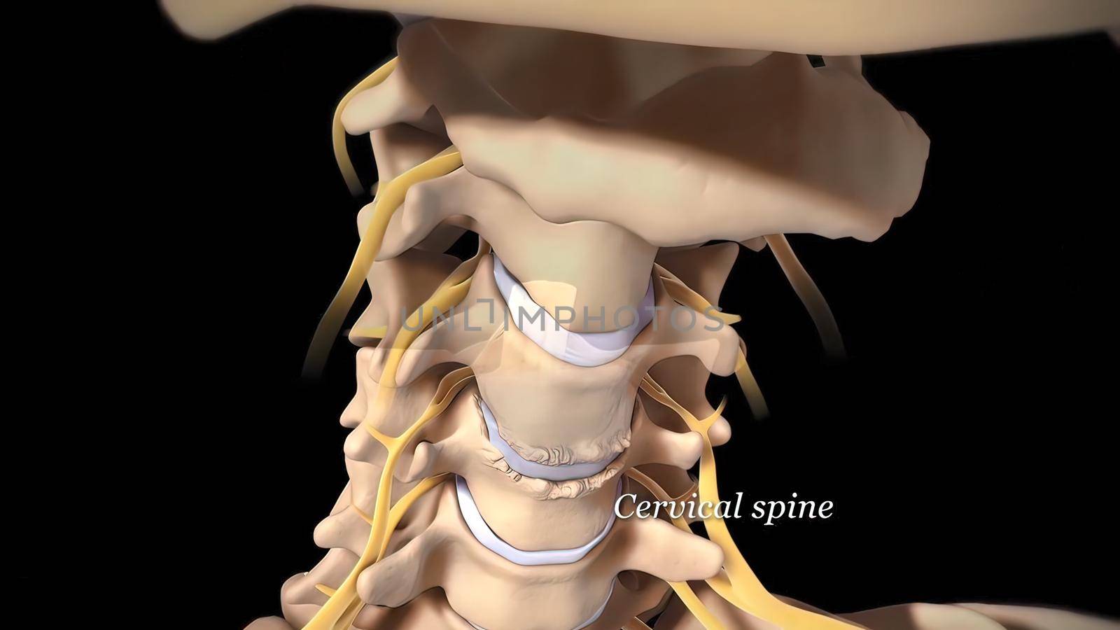 Spinal disc herniation is an injury to the cushioning and connective tissue between vertebrae, usually caused by excessive strain or trauma to the spine. 3d Render
