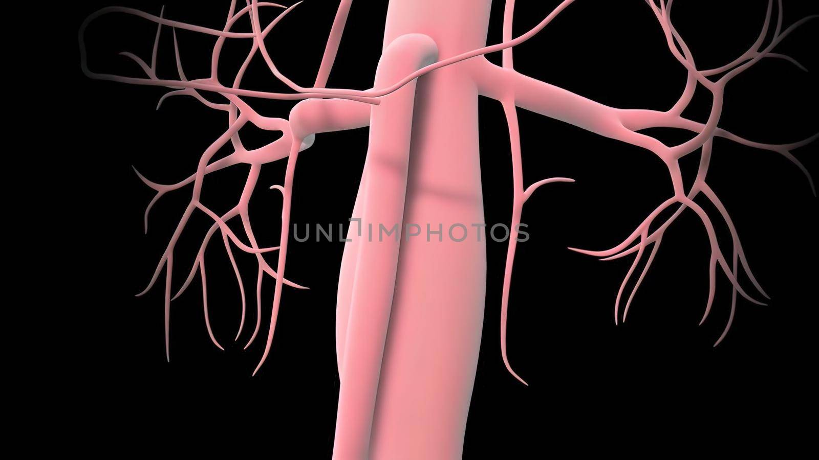 Formation of abdominal aortic aneurysm by creativepic