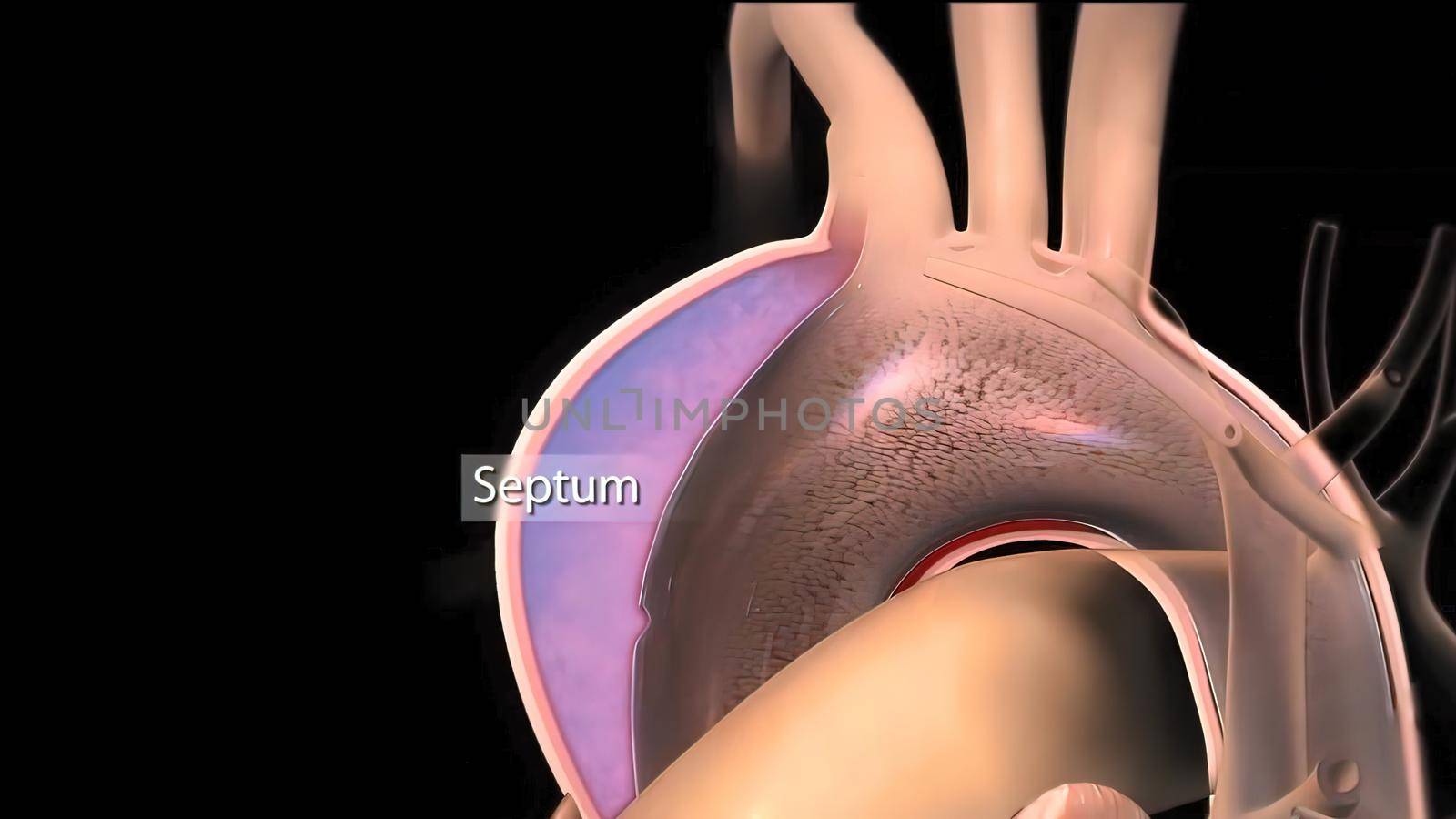 Hypoplastic left heart syndrome is a rare congenital heart defect in which the left side of the heart is severely underdeveloped.It may affect the left ventricle, aorta, aortic valve, or mitral valve. 3D Render