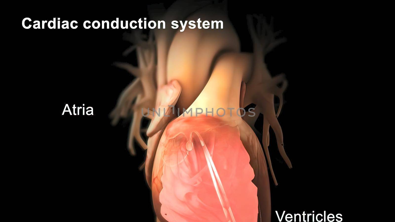 Catheter ablation is the treatment of arrhythmia with radio waves. 3D illustration