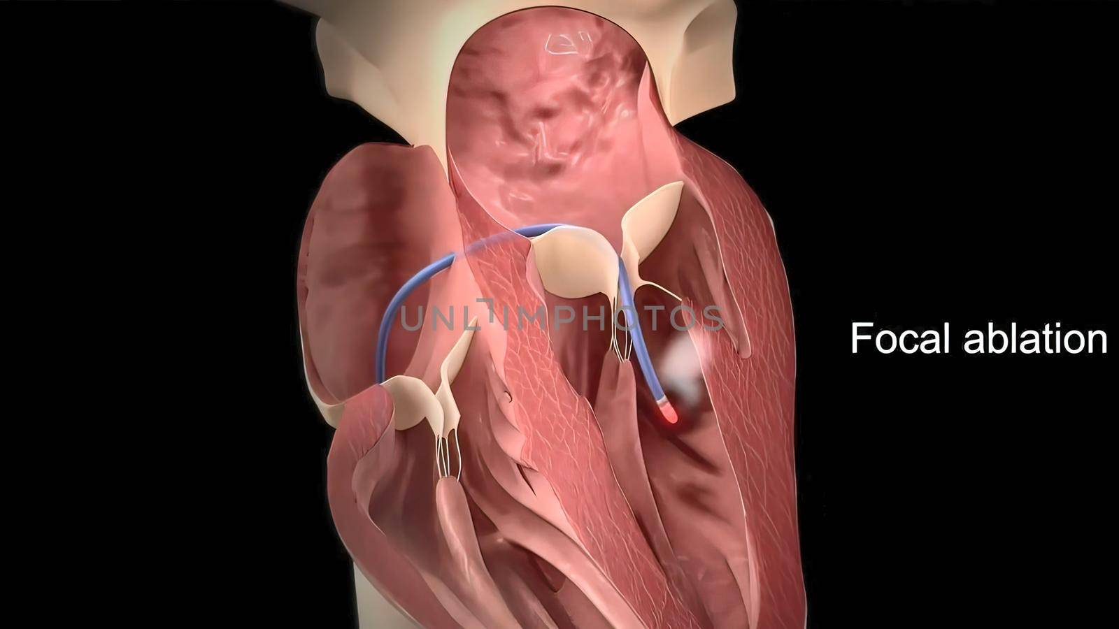 Catheter ablation is a procedure that uses energy to create tiny wounds in your heart tissue to prevent abnormal electrical signals from passing through your heart. 3D Medical illustration