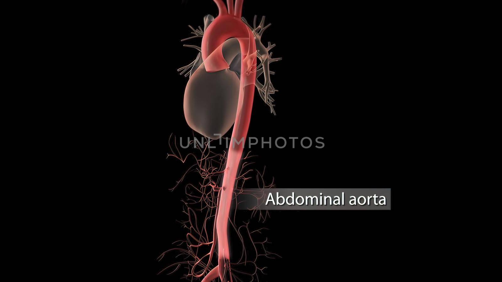 Aortic aneurysm and aortic dissection 3D Render